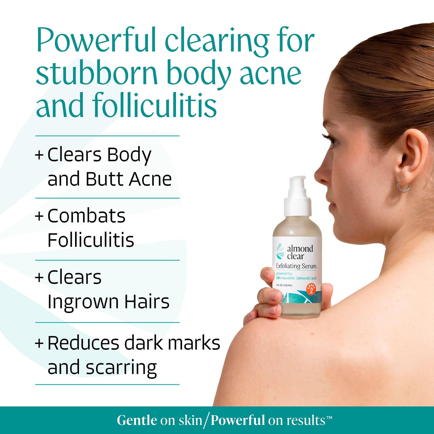 Almond Clear Mandelic Acid Level 2 Serum - Extra Strength Treatment for Body Acne, Folliculitis, and Ingrown Hairs - Buttocks Clearing Dark Spot Beauty and Personal Care Almond Clear