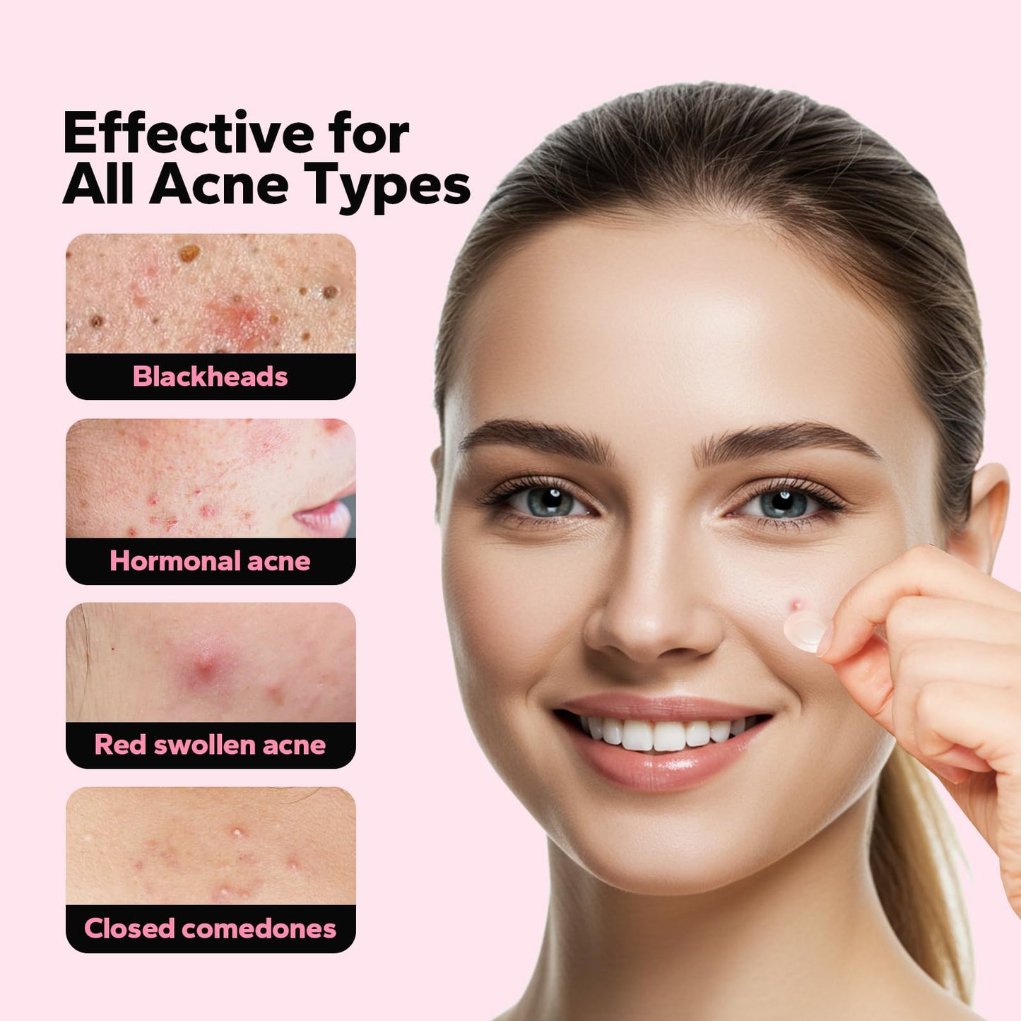CharmCherry Pimple Patches for Face (18 Count), Microdart Acne Patches, Hydrocolloid Blemish Spot with Salicylic Acid, Fast-Acting for Early Stage