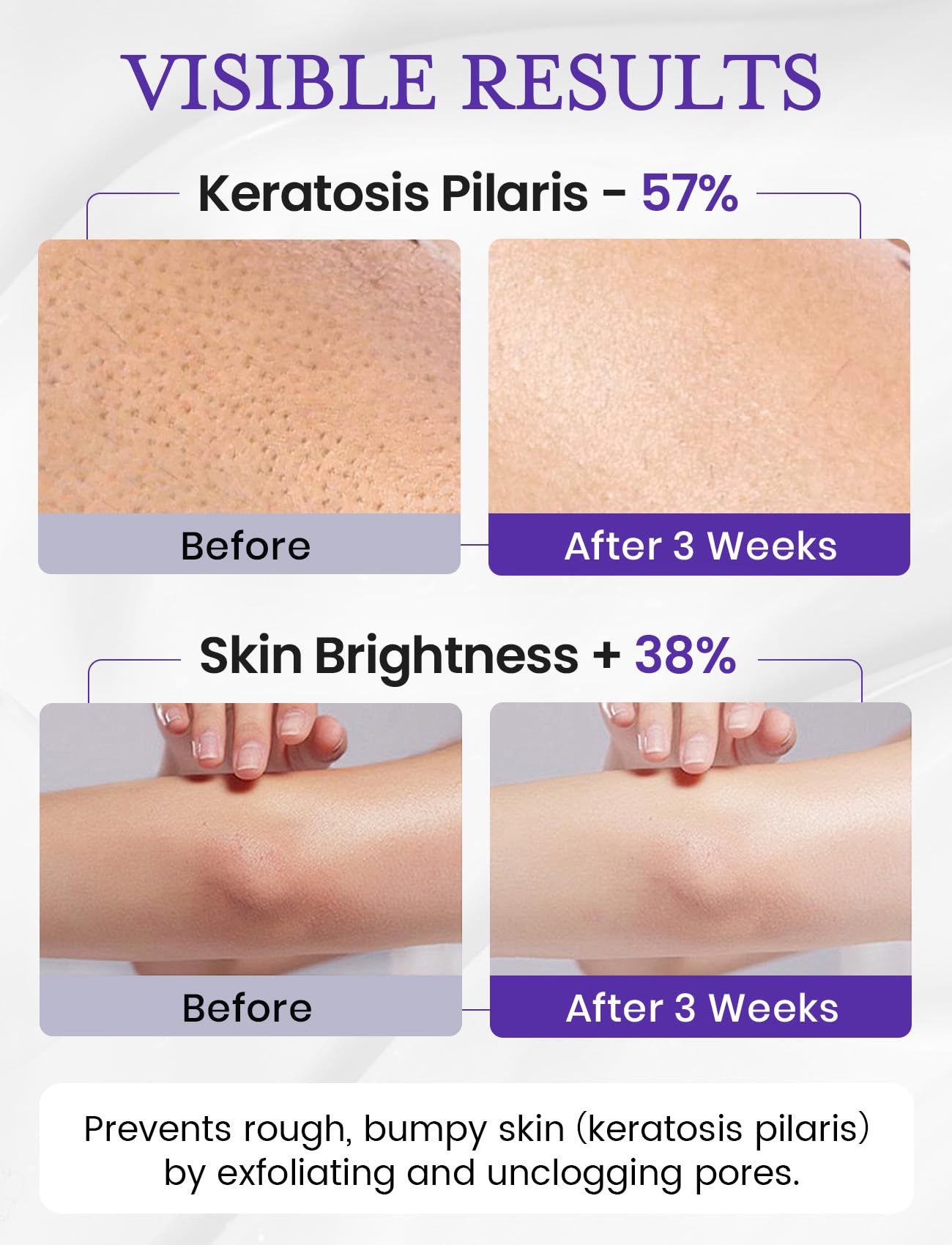 Elvira KP Bump Eraser Foot & Body Scrub, Exfoliating Scrub for Keratosis Pilaris, Smooth Skin with 10% AHA BHA & Niacinamide