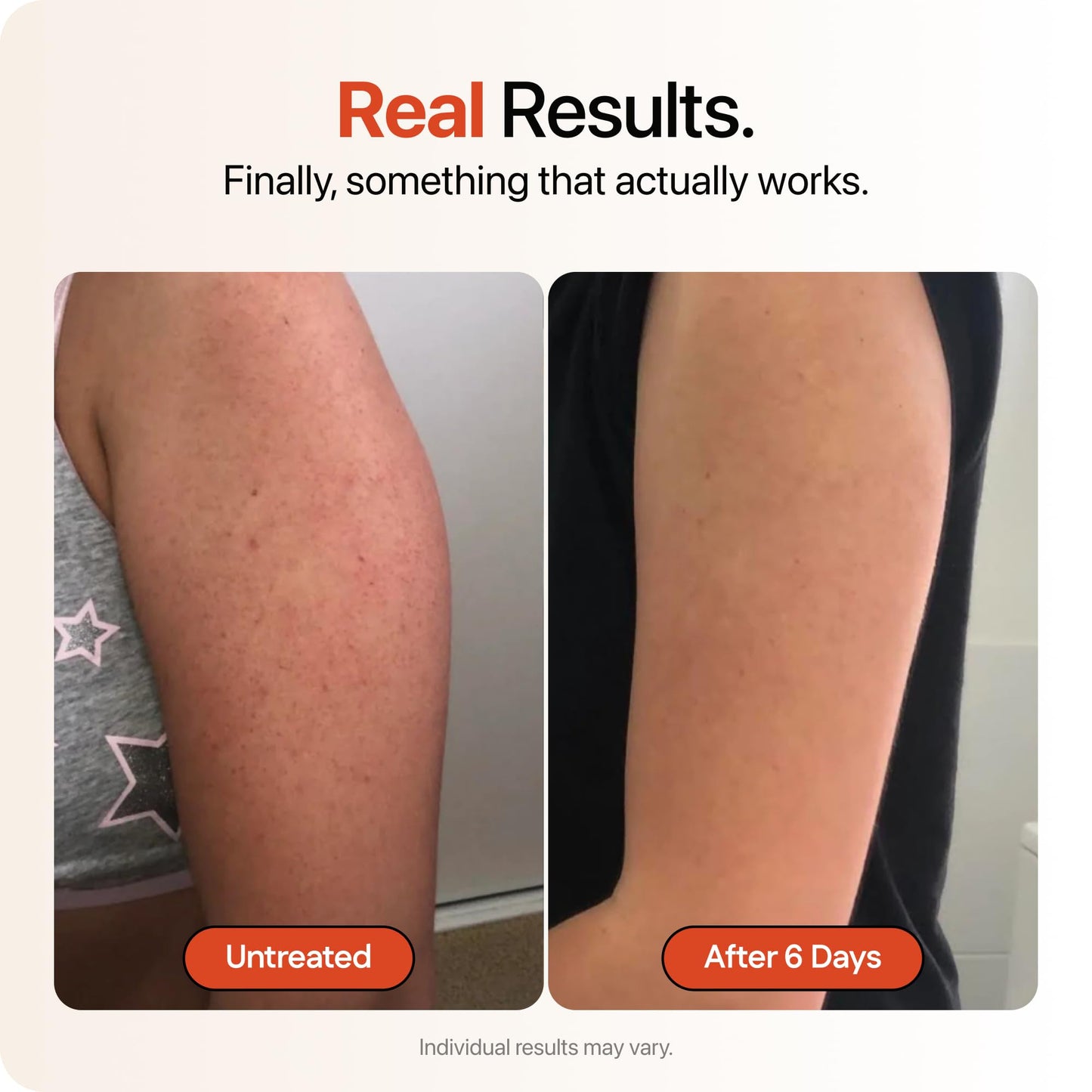 Strawberry® Resurfacing Cream for Keratosis Pilaris - KP Bump Eraser for Strawberry Skin - Exfoliating Lotion with Glycolic, Lactic & Salicylic Acid