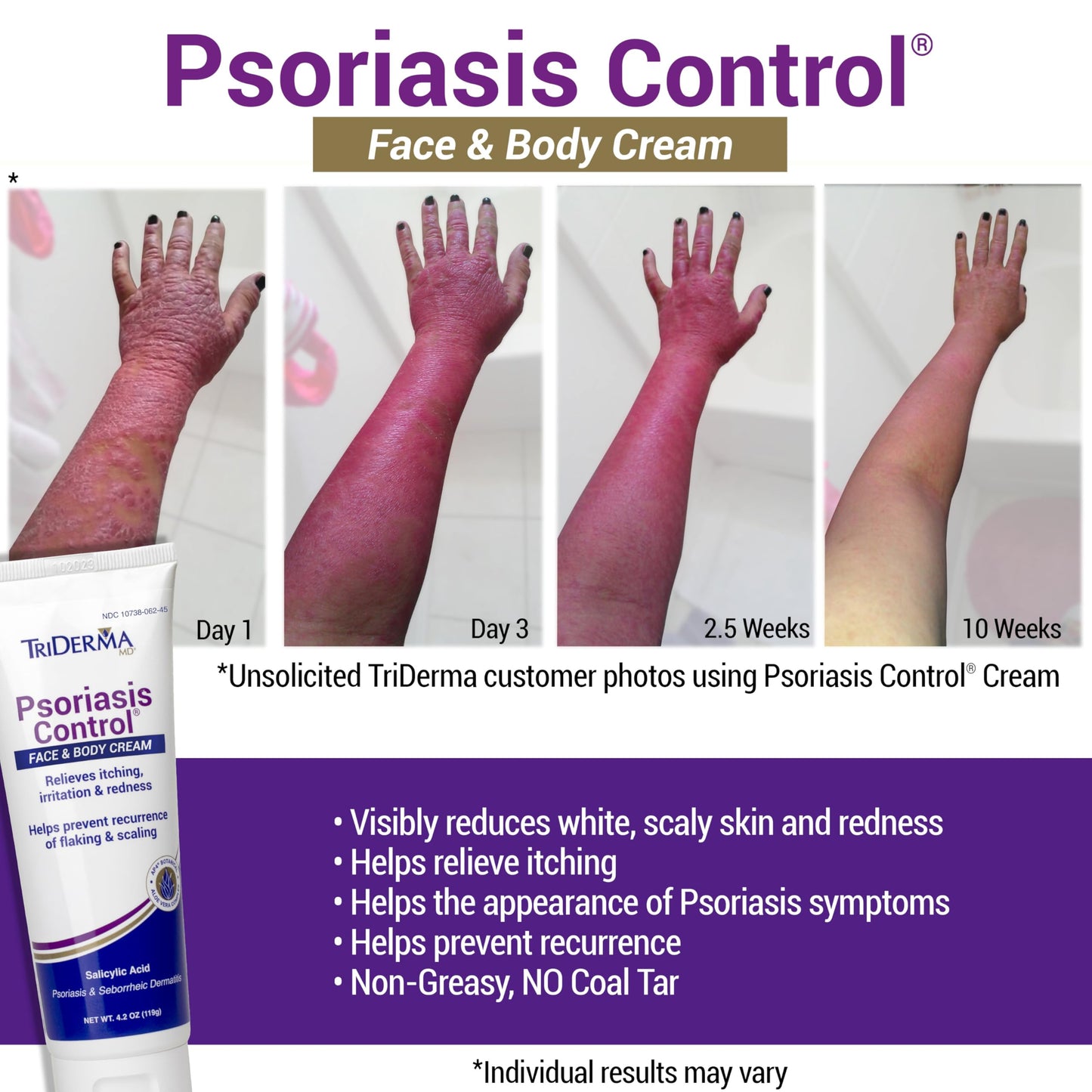TriDerma Psoriasis Control Face and Body Cream, 4.2 Ounces