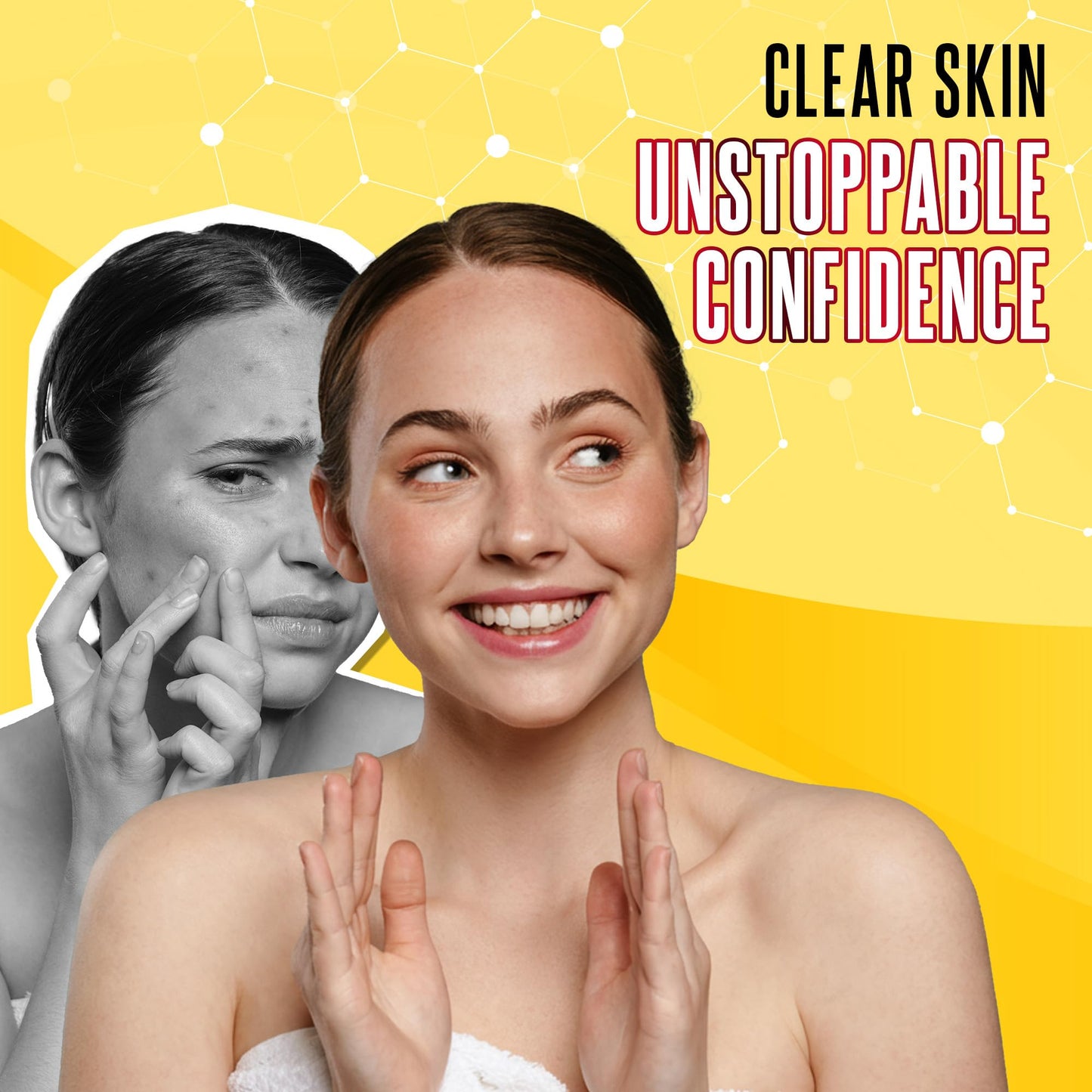 Biosulfur Grisi Acne Treatment Soap: Deep Cleansing, Acne-Fighting, Reduces Inflammation, Prevents Breakouts, Blackheads, Excess Oil, Sulfur Soap Bar