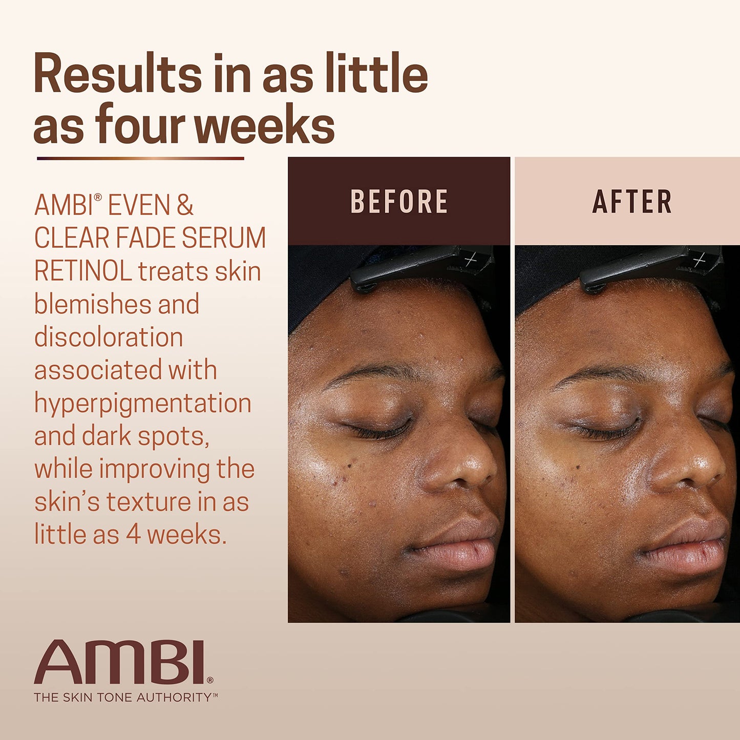Ambi Even & Clear Fade Serum, Hyperpigmentation Treatment, Hydroquinone-free, Dark Spot Corrector, Results In As Little As 4 Weeks, Retinol