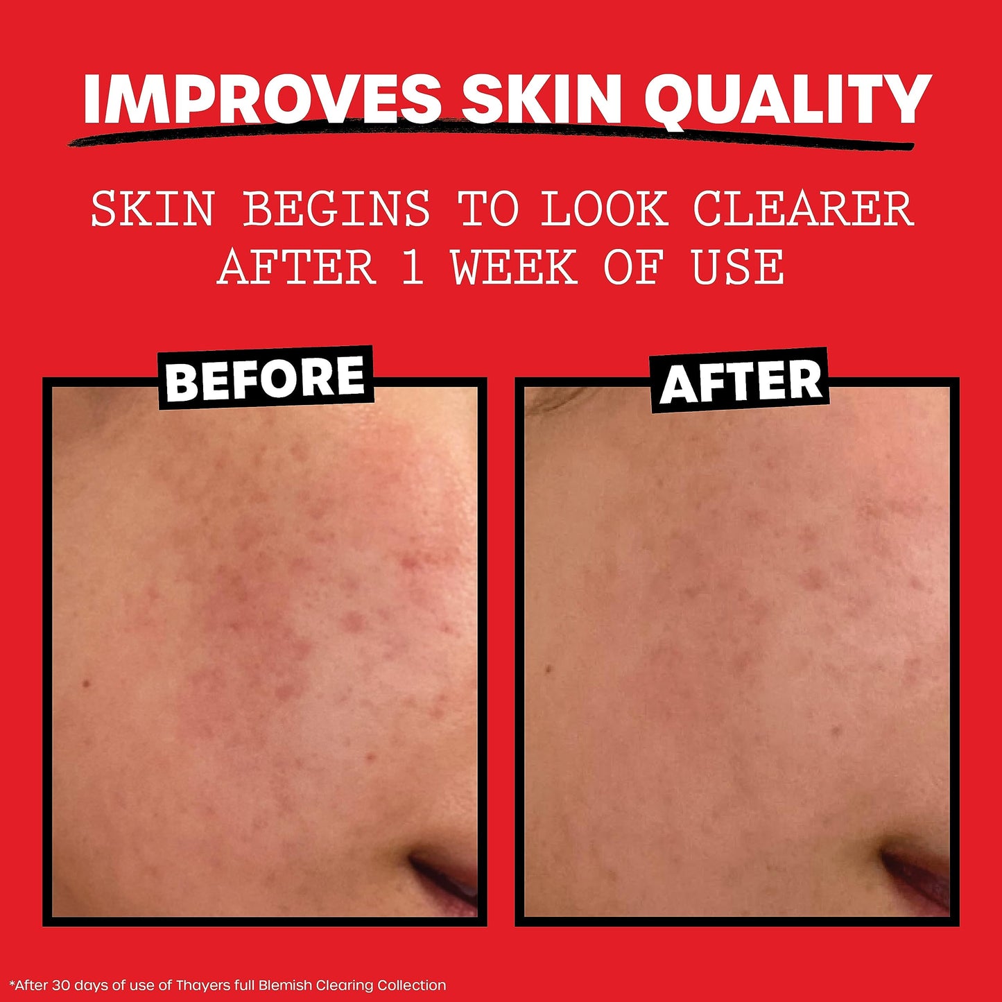 THAYERS Witch Hazel Blemish Cleanser, 4 Ounce