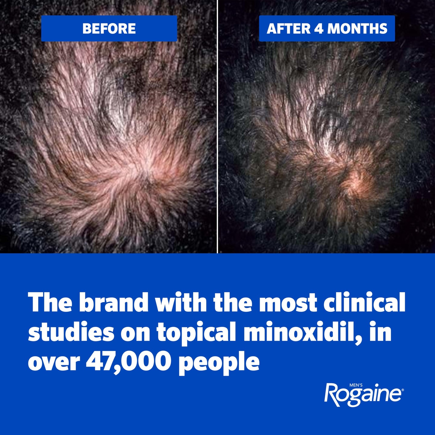 Men's Rogaine Extra Strength 5% Minoxidil Solution, 3 Mo Supply, 3x 2 Fl Oz Beauty and Personal Care Rogaine