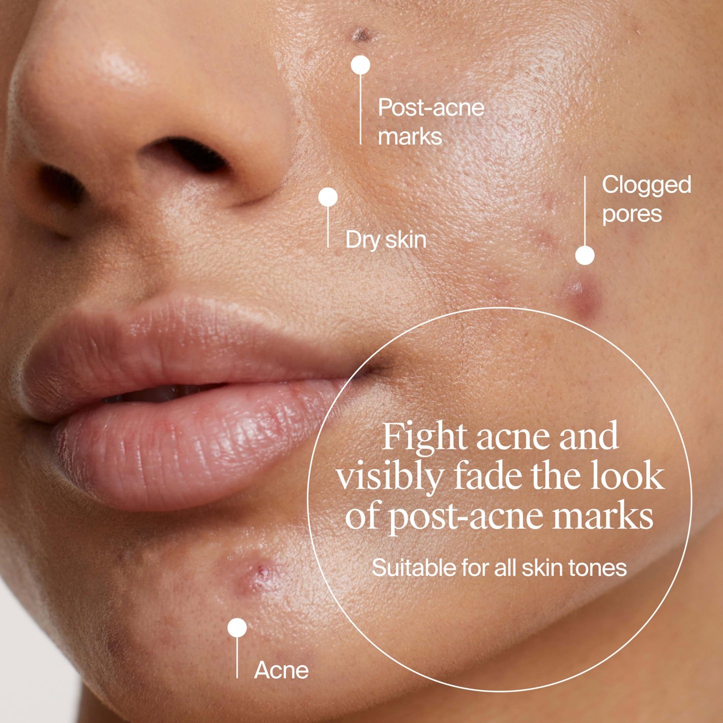 Neutrogena Evenly Clear Acne Gel Moisturizer with Salicylic Acid & N-Acetyl Glucosamine, Lightweight Non-Greasy Face Moisturizer Helps Treat Breakouts