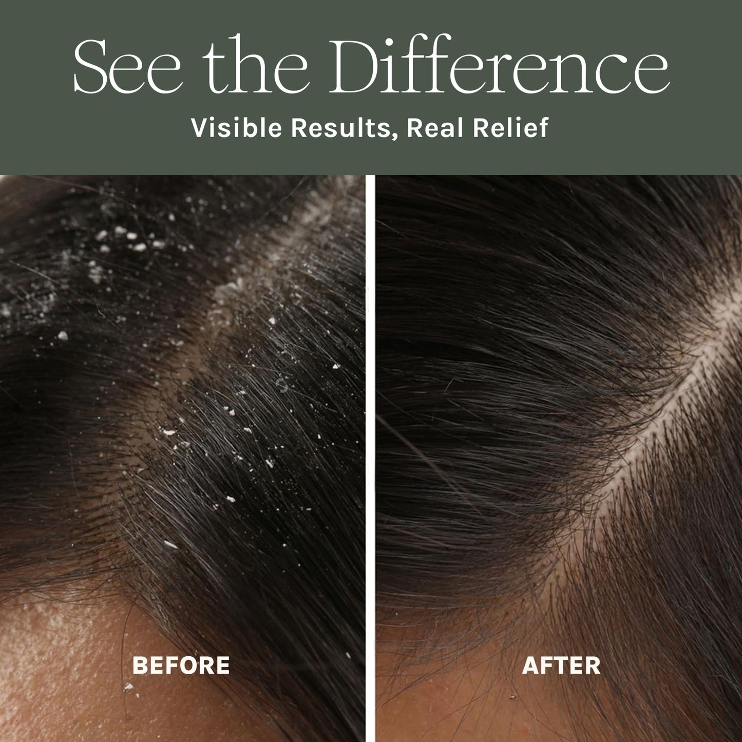 Antifungal Antibacterial Scalp Mask - Boost Hair Growth - Natural Detoxifying Treatment - Nourish with Aloe, Neem, Rosemary, Apple Cider Vinegar