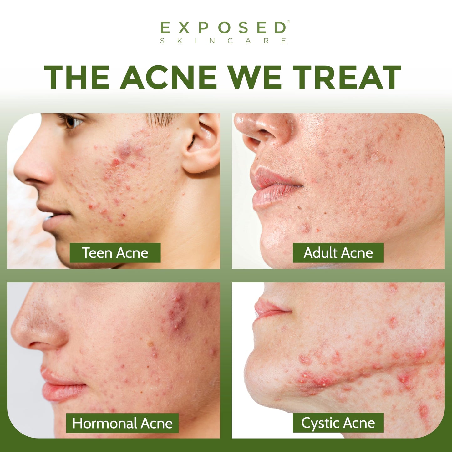 Exposed Skin Care, Acne Facial Cleanser with 0.5% Salicylic Acid for Sensitive and Acne-Prone Skin - Gentle Daily Face Wash for Breakout, Blackhead