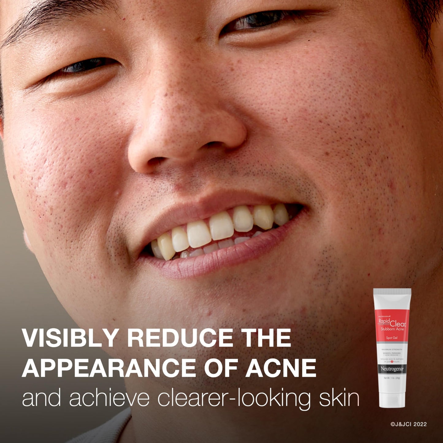 Neutrogena Rapid Clear Stubborn Acne Spot Treatment Gel with Maximum Strength 10% Benzoyl Peroxide Acne Treatment Medication, Pimple Cream for Acne