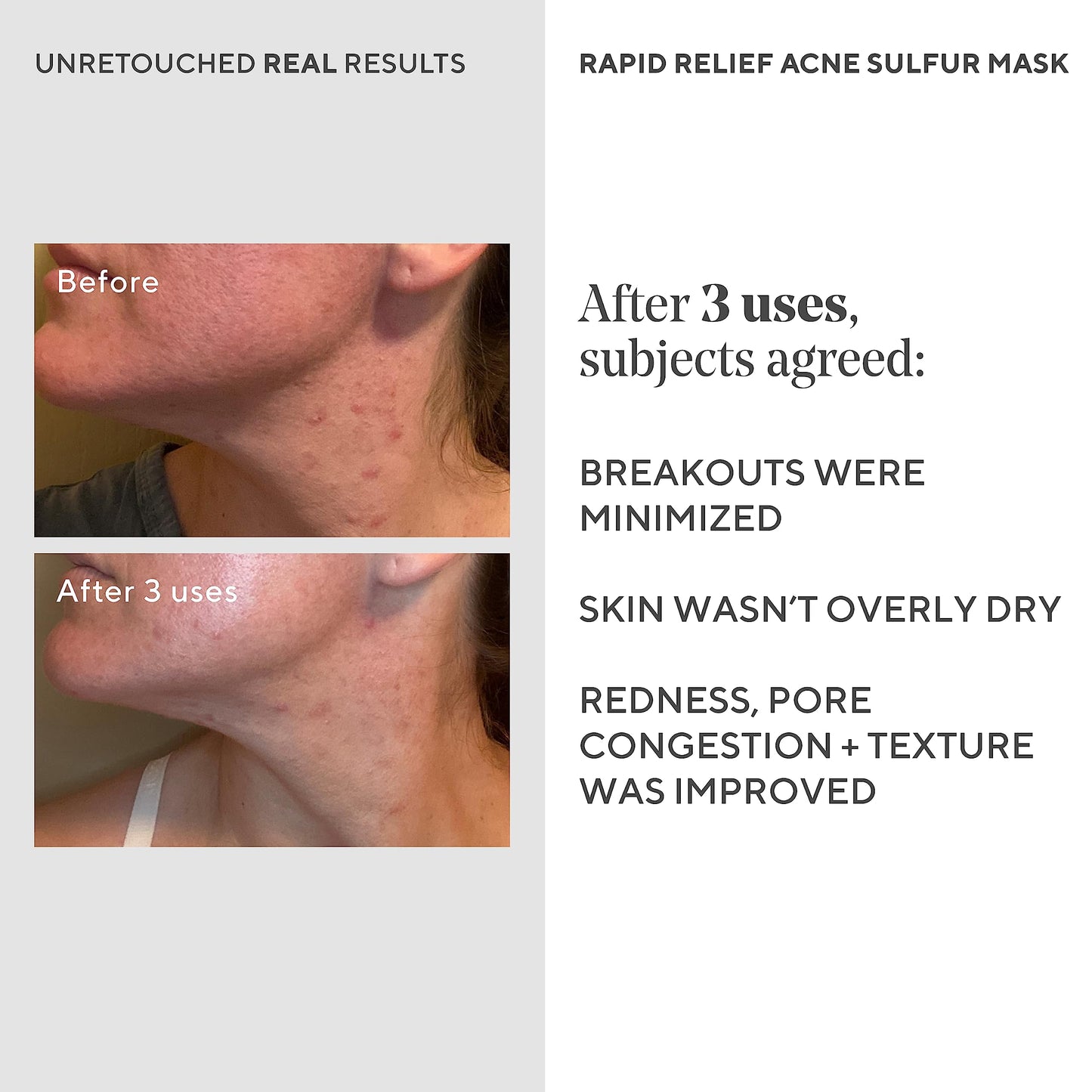 Murad Rapid Relief Acne Sulfur Mask - Clay Mask with Salicylic Acid, 5% Sulfur, and Austrian Peat Reduces Oil, Minimizes Breakouts, Reduces Pimple