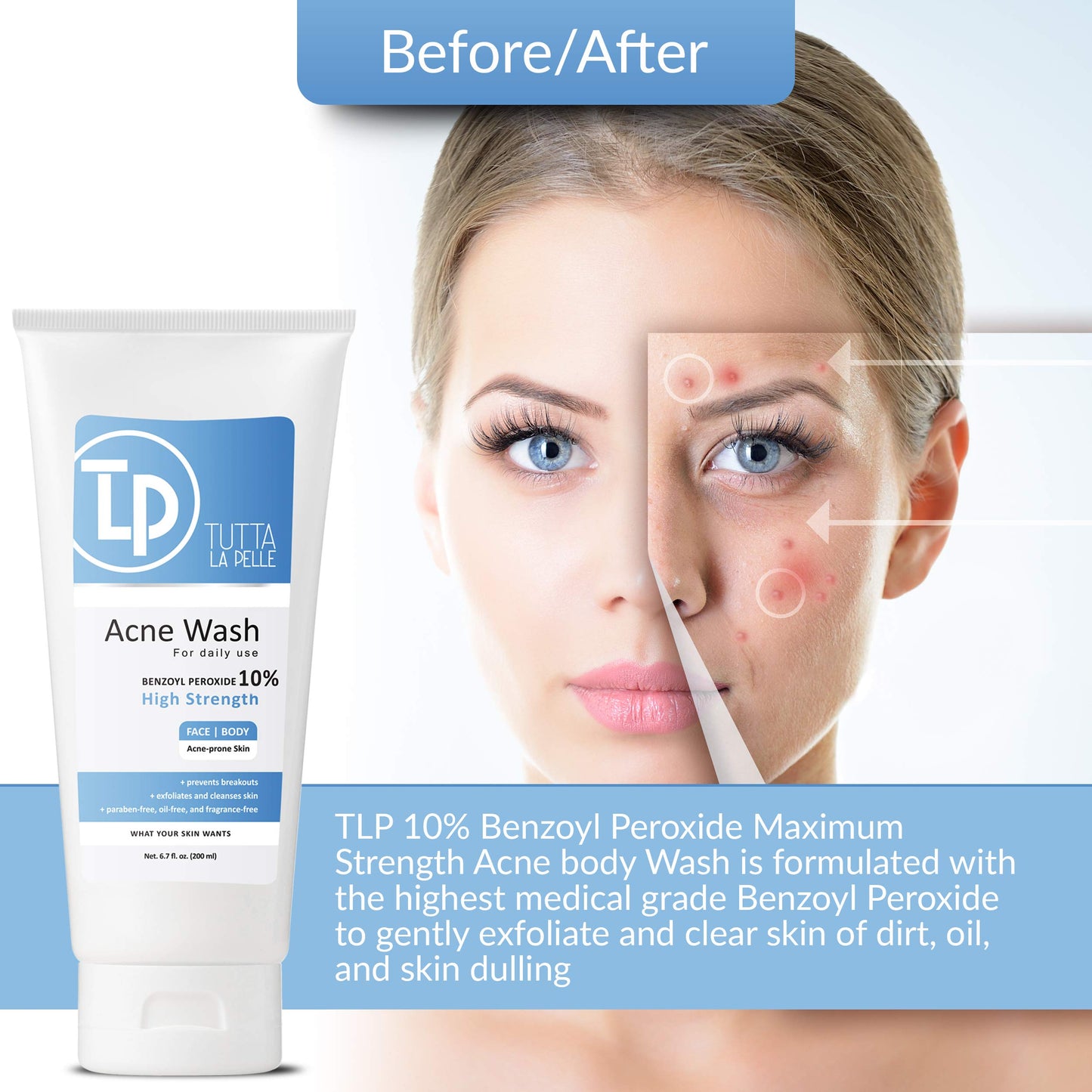 Tutta La Pelle Benzoyl Peroxide Body Wash 10% - Acne Face Wash & Acne Body Wash - Butt Acne Treatment & Back Acne Treatment - Highest Grade Medical