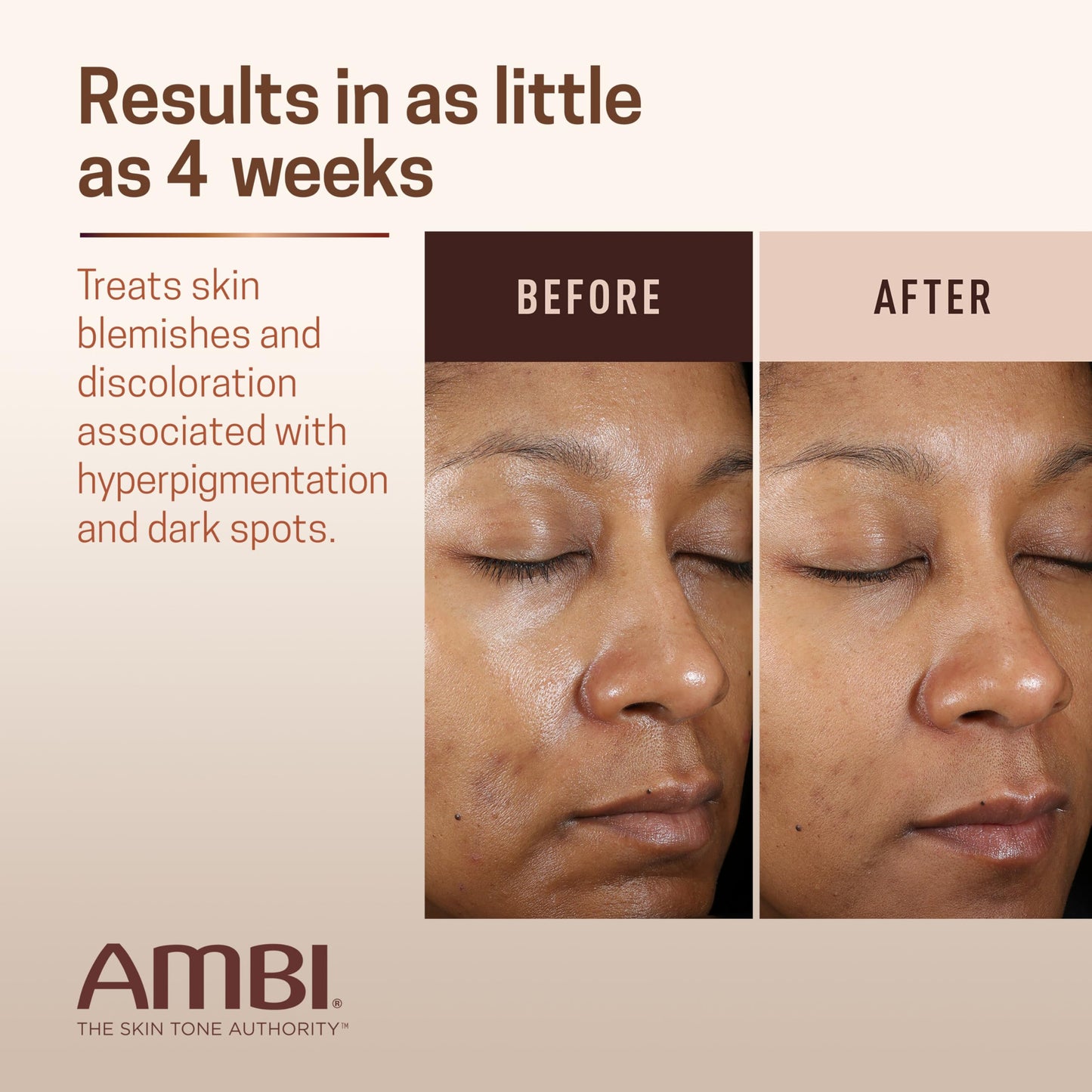 Ambi Even & Clear Advanced Fade Cream, Hydroquinone-free, Hyperpigmentation Treatment, Stubborn Dark Spot Corrector, Results In As Little As 2-3