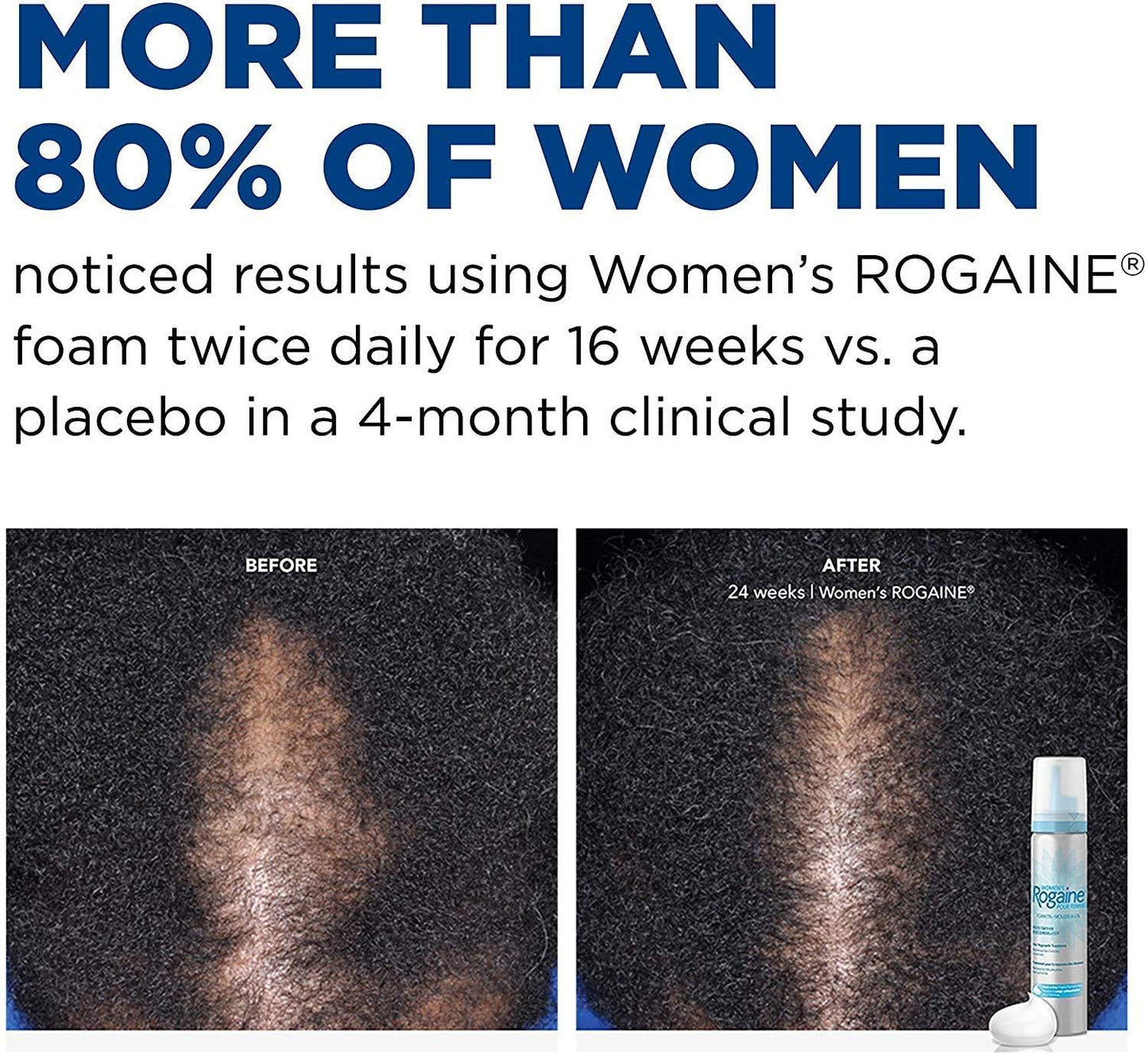 Rogaine 5% Minoxidil Foam, Topical Once-A-Day Hair Loss Treatment for Women to Regrow Fuller, Thicker Hair, Unscented, 2-Month Supply, 2.11 oz Beauty and Personal Care Rogaine