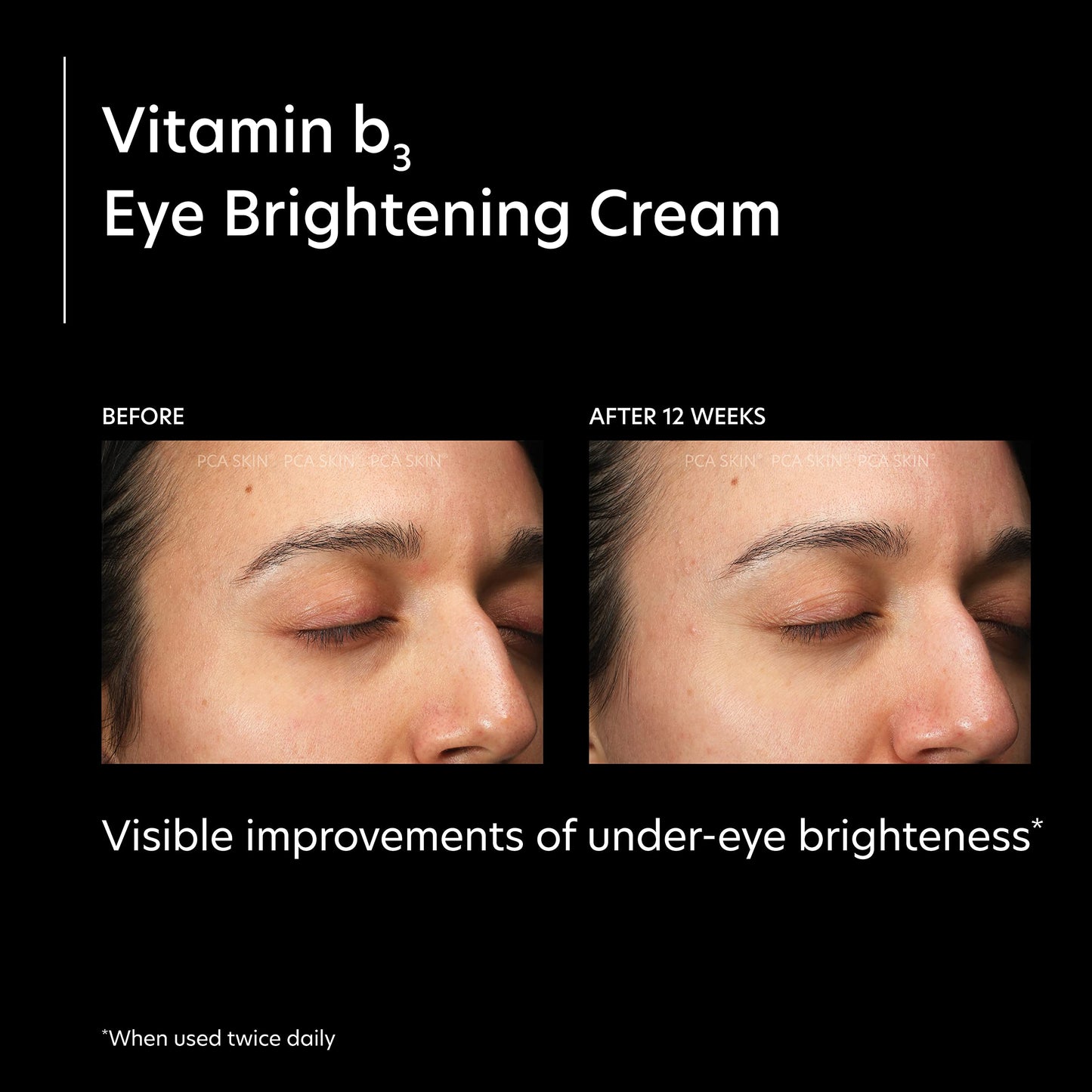 PCA SKIN Vitamin B3 Eye Brightening Cream, Eye Brightener For Bright Eyes, Dark Circles, Wrinkles, and Uneven Skin Tones, Anti Aging Eye Cream