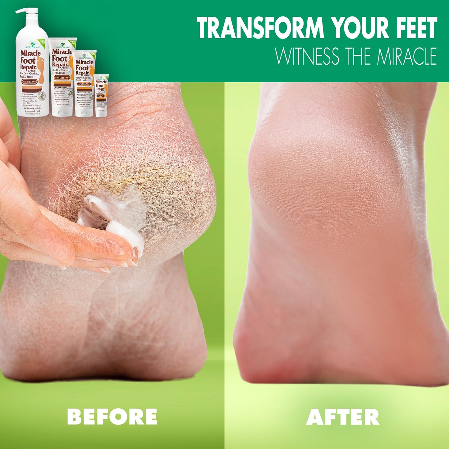 Miracle Foot Repair Cream, 4 oz Repairs Dry Cracked Heels and Feet, Diabetic-Safe, 60% Pure Ultra Aloe Moisturizes, Softens, and Repairs, Relief from