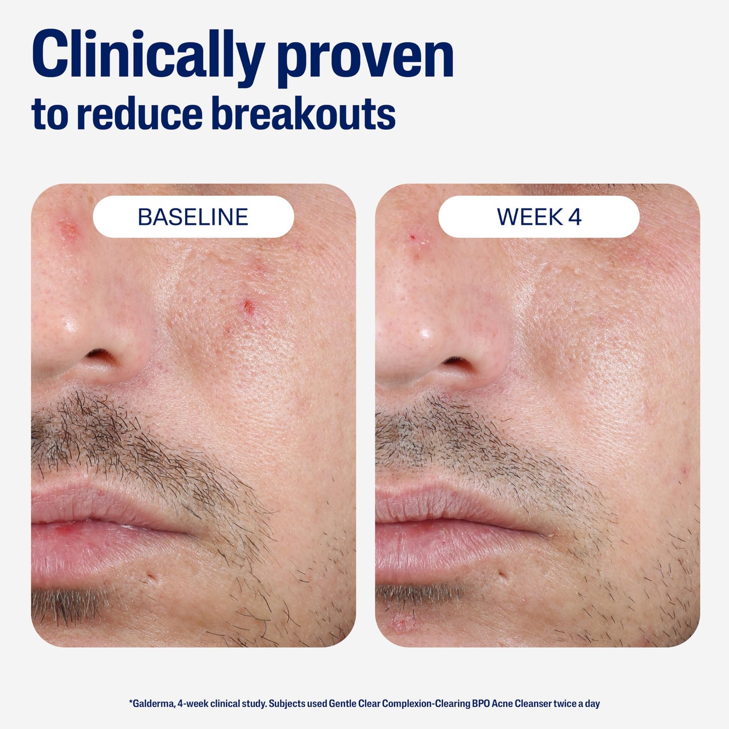 Cetaphil Gentle Clear Complexion-Clearing BPO Acne Cleanser with 2.6% Benzoyl Peroxide, Creamy and Soothing for Sensitive Skin, Suitable for All Skin