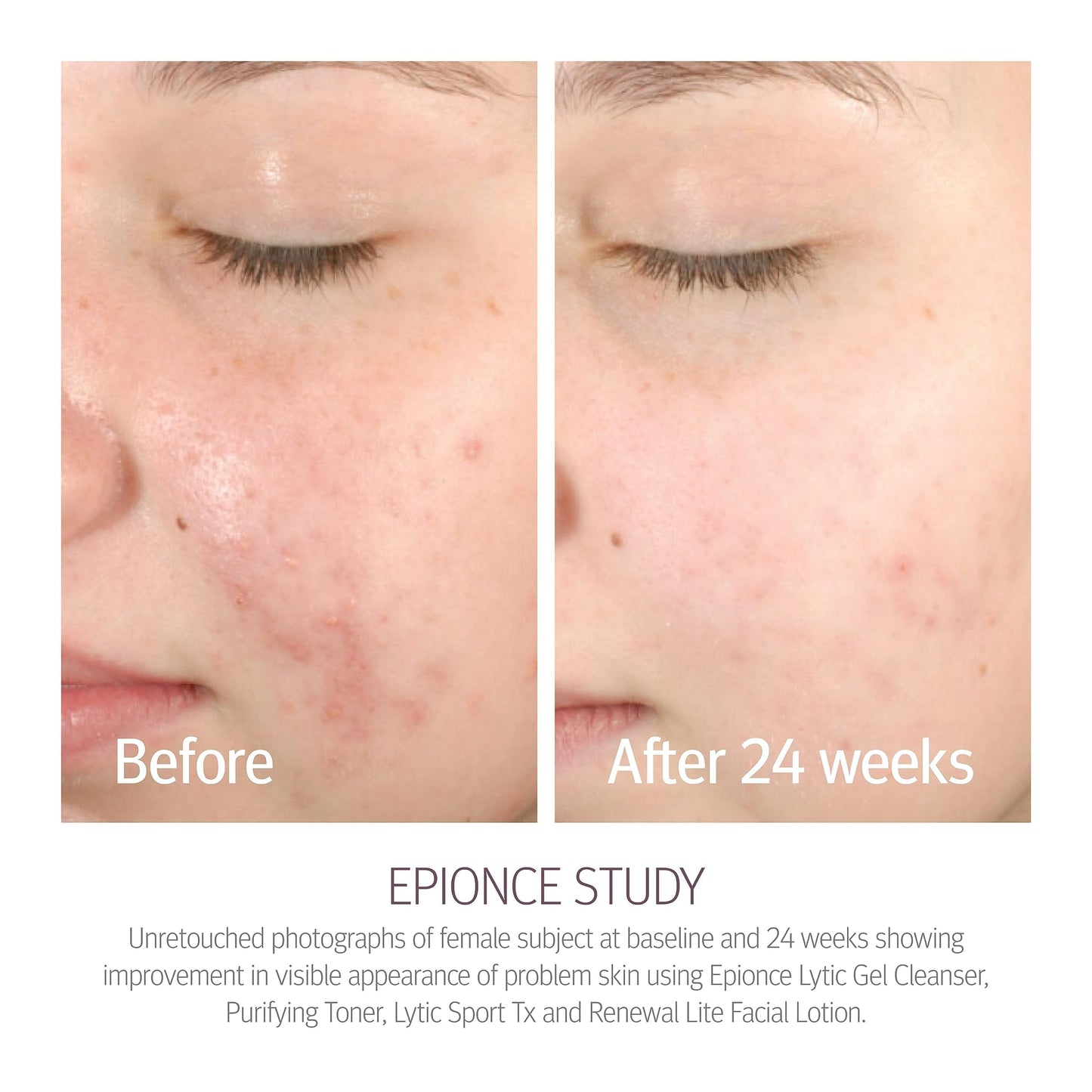 Epionce Purifying Toner - Acne & Blackhead Control Toner for Face & Body | Removes Dirt, Oil & Makeup | Willow Bark, Cucumber & Menthol |