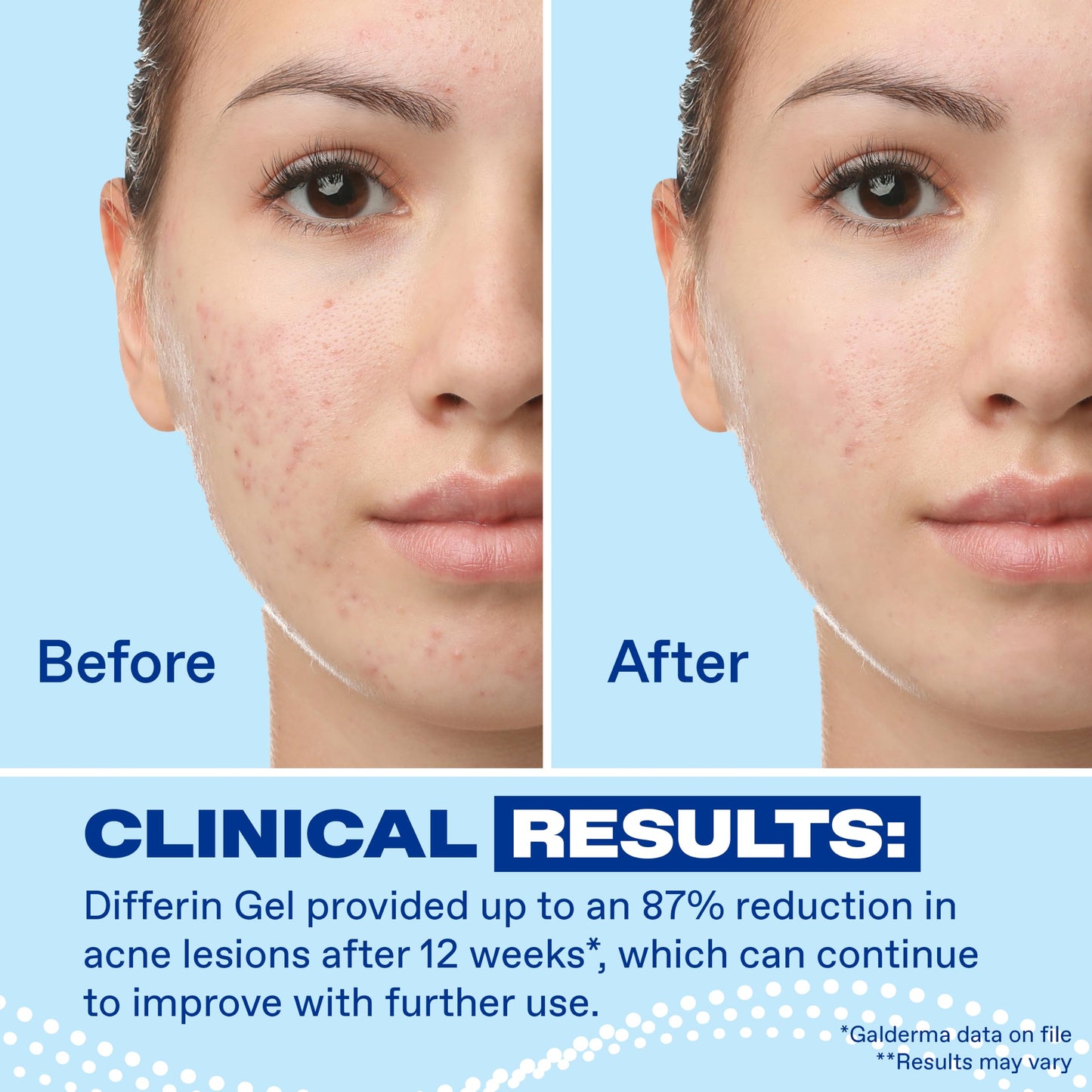 Differin Acne Treatment Gel, 90 Day Supply, Retinoid Treatment for Face with 0.1% Adapalene, Gentle Skin Care for Acne Prone Sensitive Skin, 45g Pump Beauty and Personal Care Differin