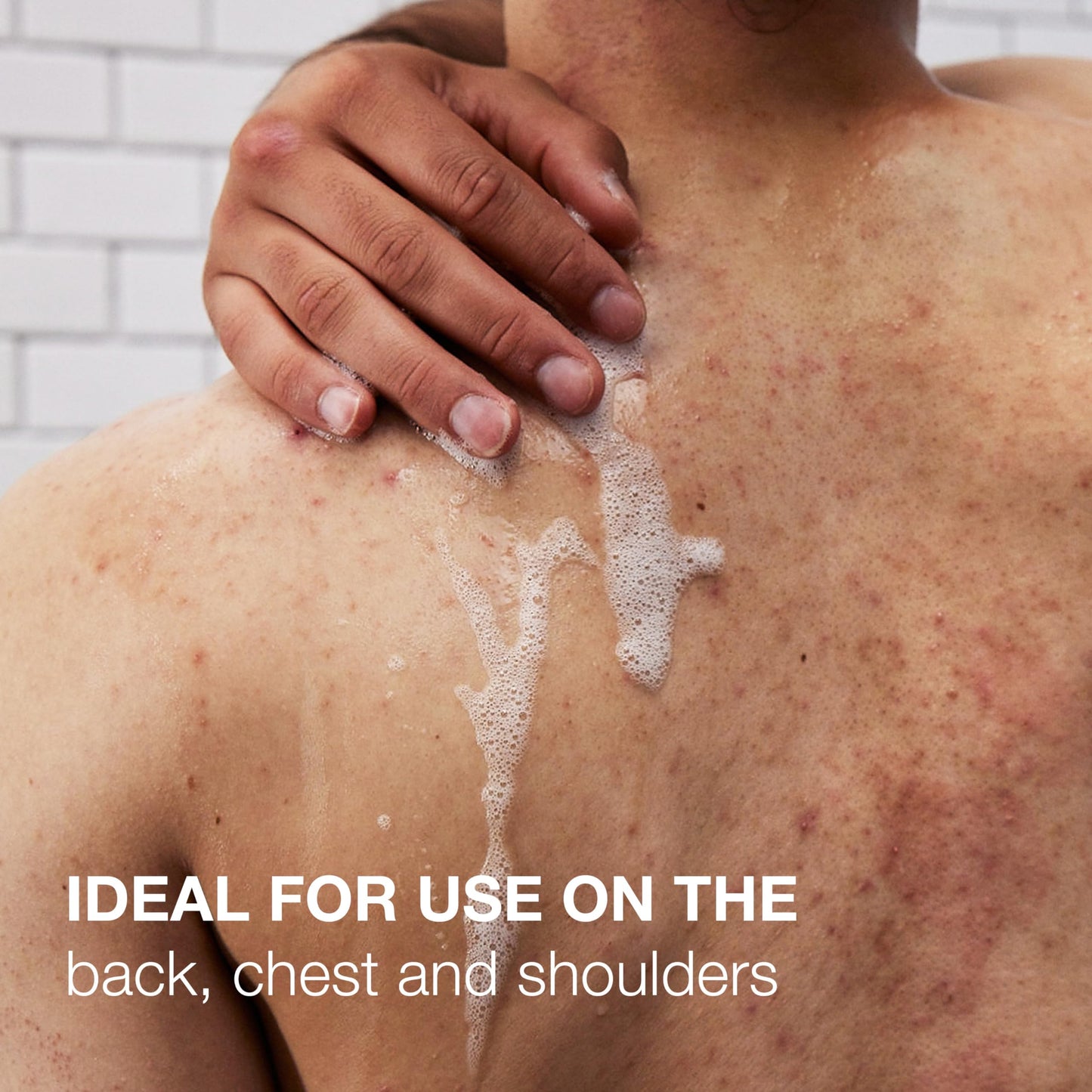 Neutrogena Stubborn Acne Body Wash 8.5 oz – Salicylic Acid & PHA Exfoliating Cleanser for Chest, Back & Shoulders | Clears & Prevents Breakouts