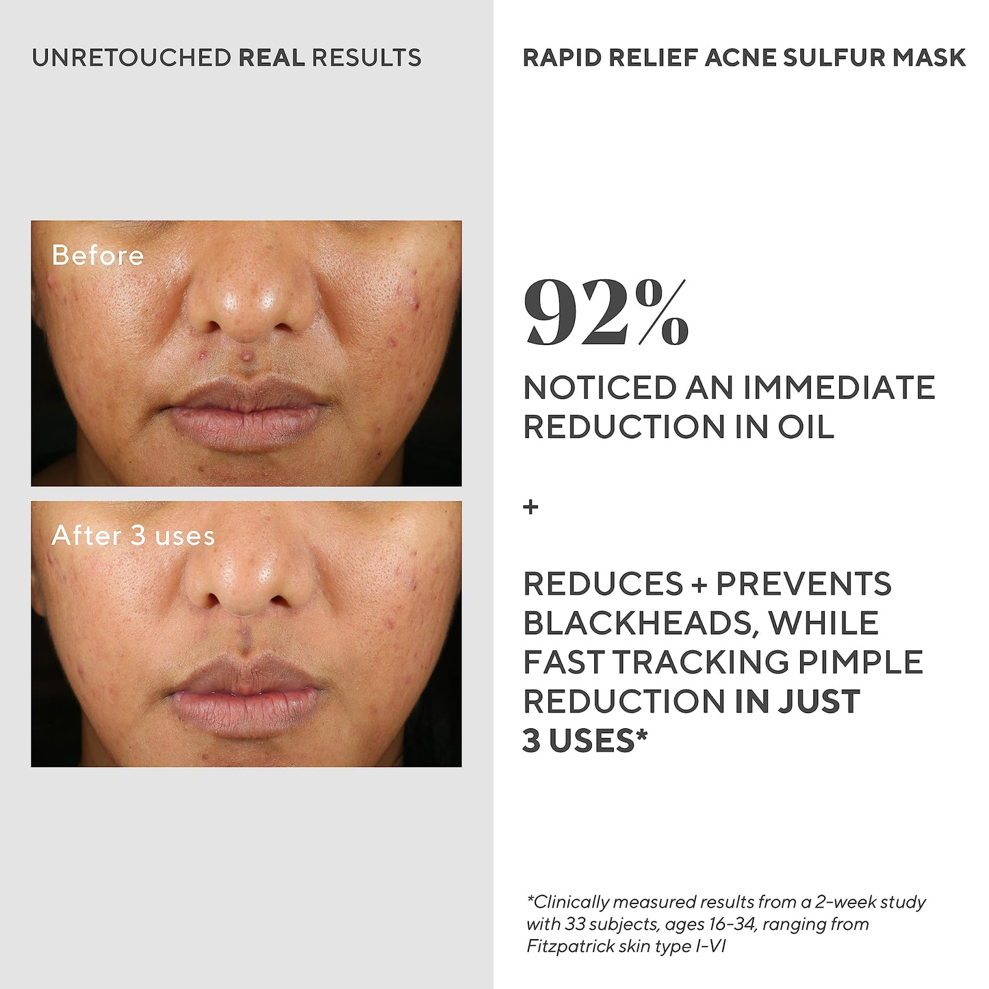 Murad Rapid Relief Acne Sulfur Mask - Clay Mask with Salicylic Acid, 5% Sulfur, and Austrian Peat Reduces Oil, Minimizes Breakouts, Reduces Pimple