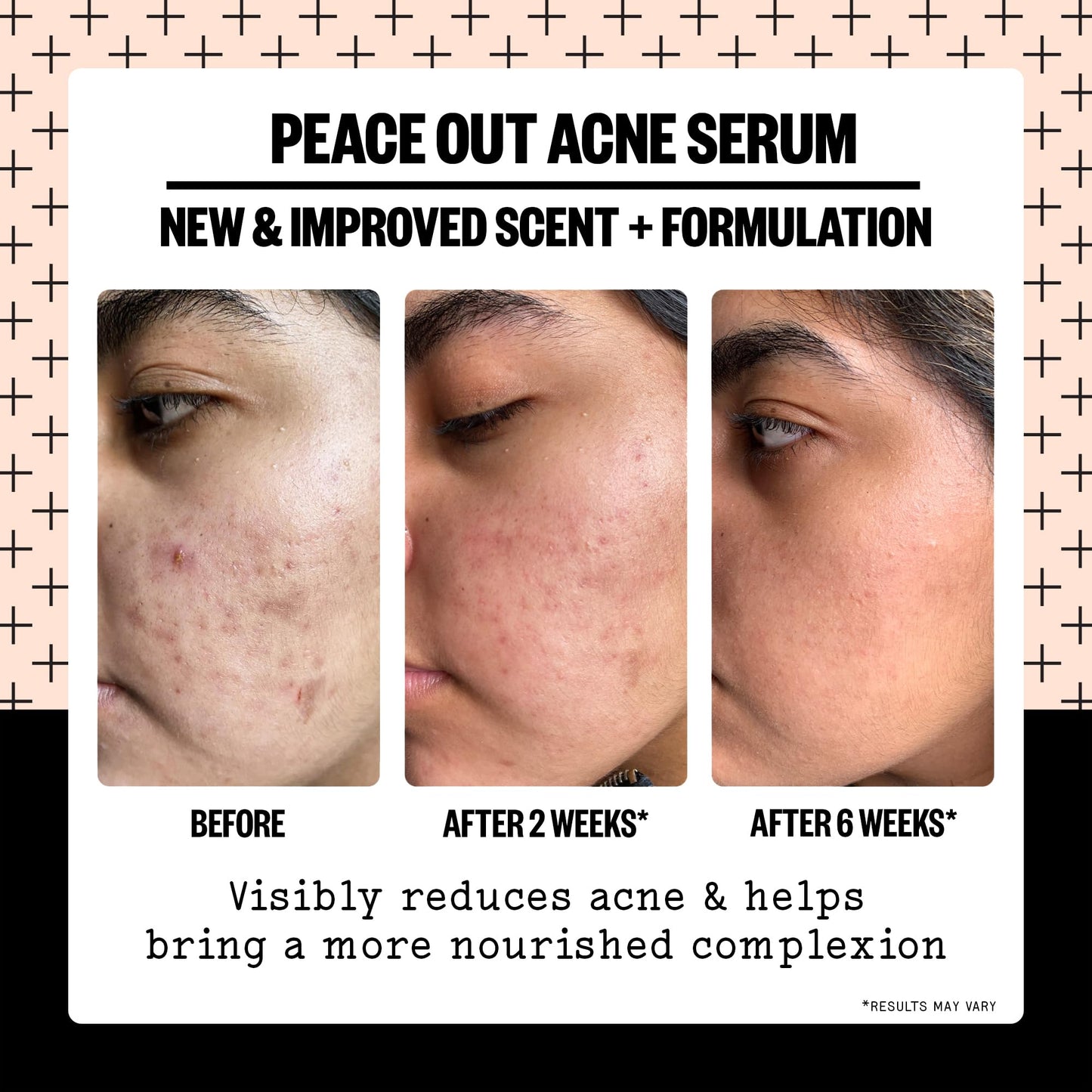 PEACE OUT Skincare Acne Serum. Daily Multi-Benefit Face Serum with 2% Salicylic Acid to Target Pimples, Zits, Blemishes and Breakouts