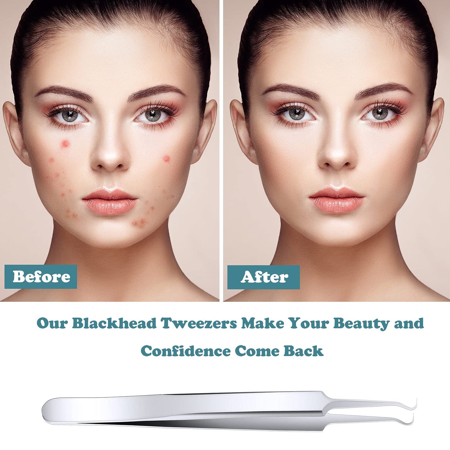 ANCIRS 6 Pack Acne Pimple Blackhead Remover Tweezers, Stainless Steel Acne Tweezers, Curved Pimple Tweezers Extractors Tool for Blackhead Blemish