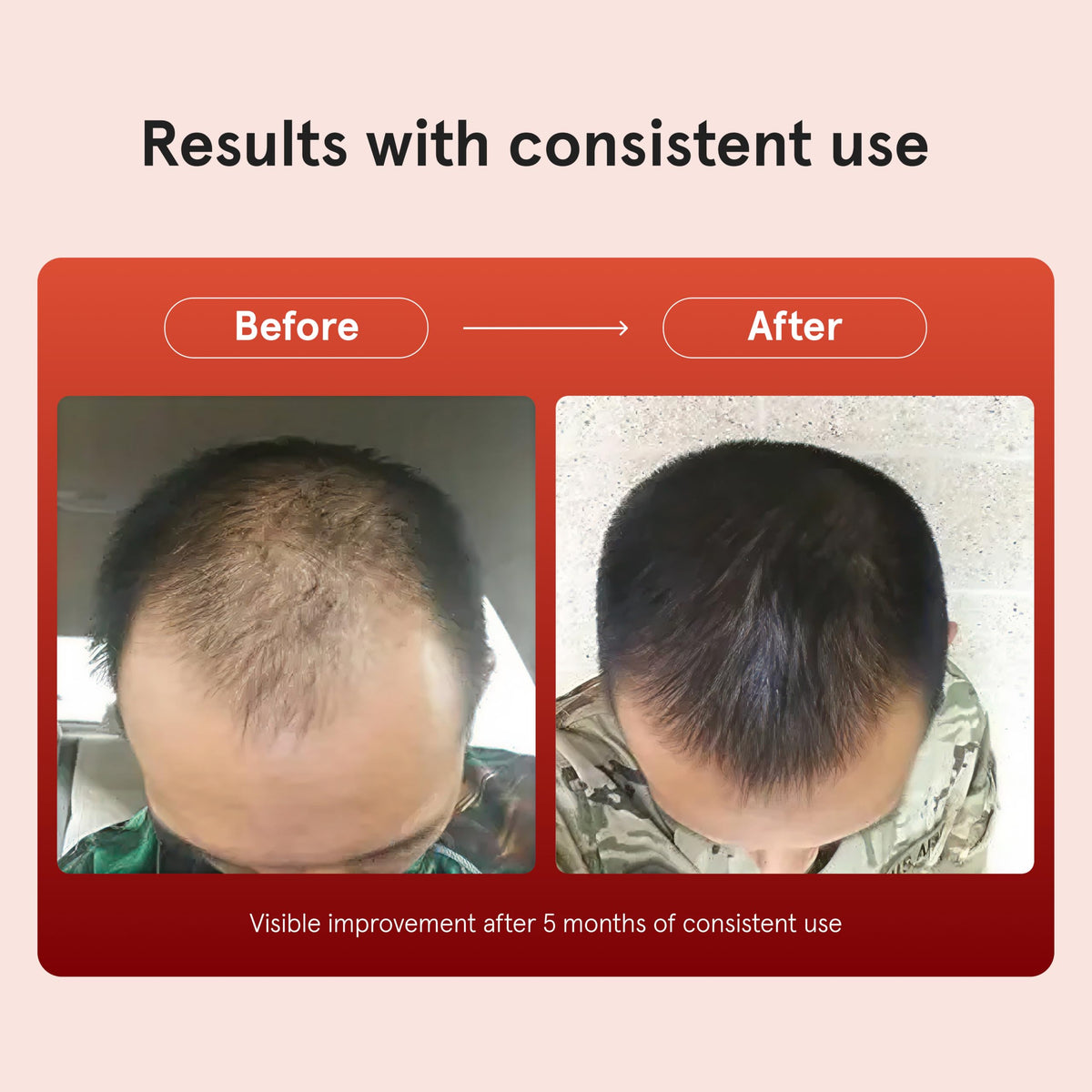 Keeps Minoxidil Solution 5% for Men, 3 Month Supply (3 x 2 fl oz Bottles) Beauty and Personal Care Keeps