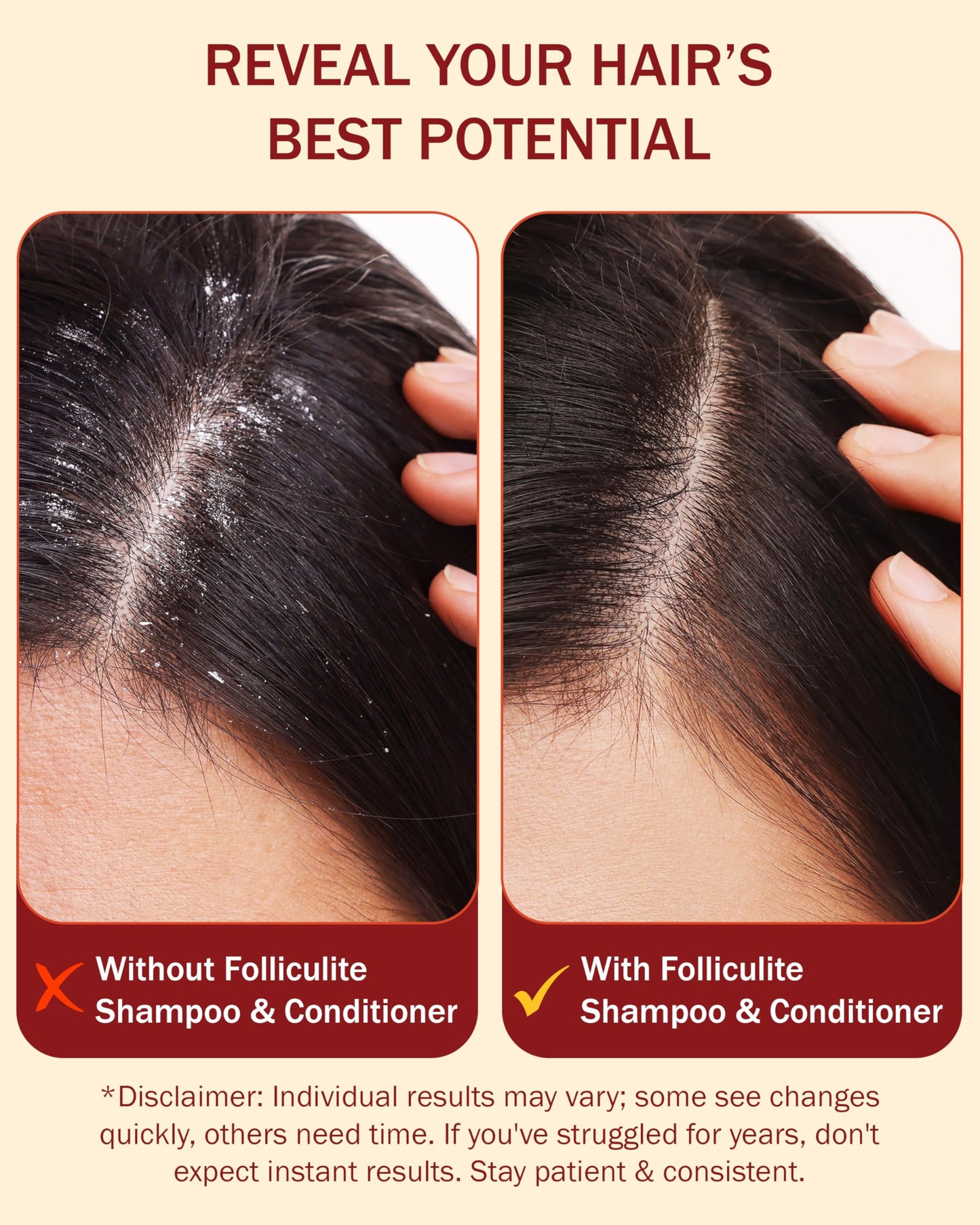 Folliculitis Treatment Shampoo and Conditioner with 3% BHA, Salicylic Acid, Aloe Vera & Tea Tree Oil - Anti Itch Shampoo for women & men with Flaky