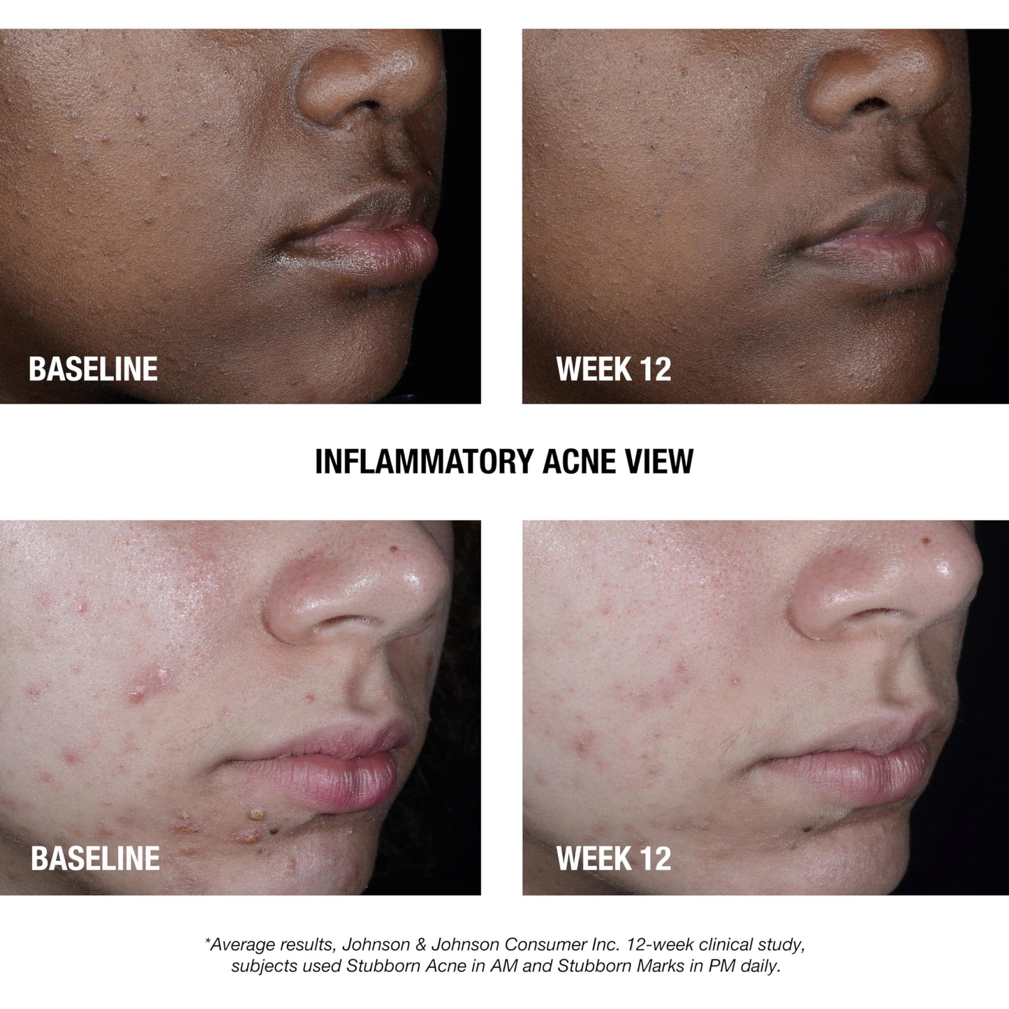 Neutrogena Stubborn Acne AM Face Treatment with 2.5% Micronized Benzoyl Peroxide Acne Medication, Oil-Free Daily Facial Treatment Reduces Size