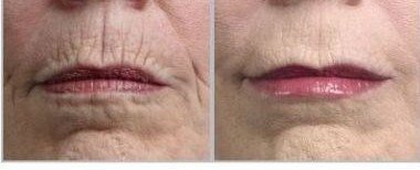 Gaba Freeze 24/7 Serum for Skin tightening, firming and sagging prevention. Also has 17% GABA (Gamma Amino Butryic Acid) causes Crease Release