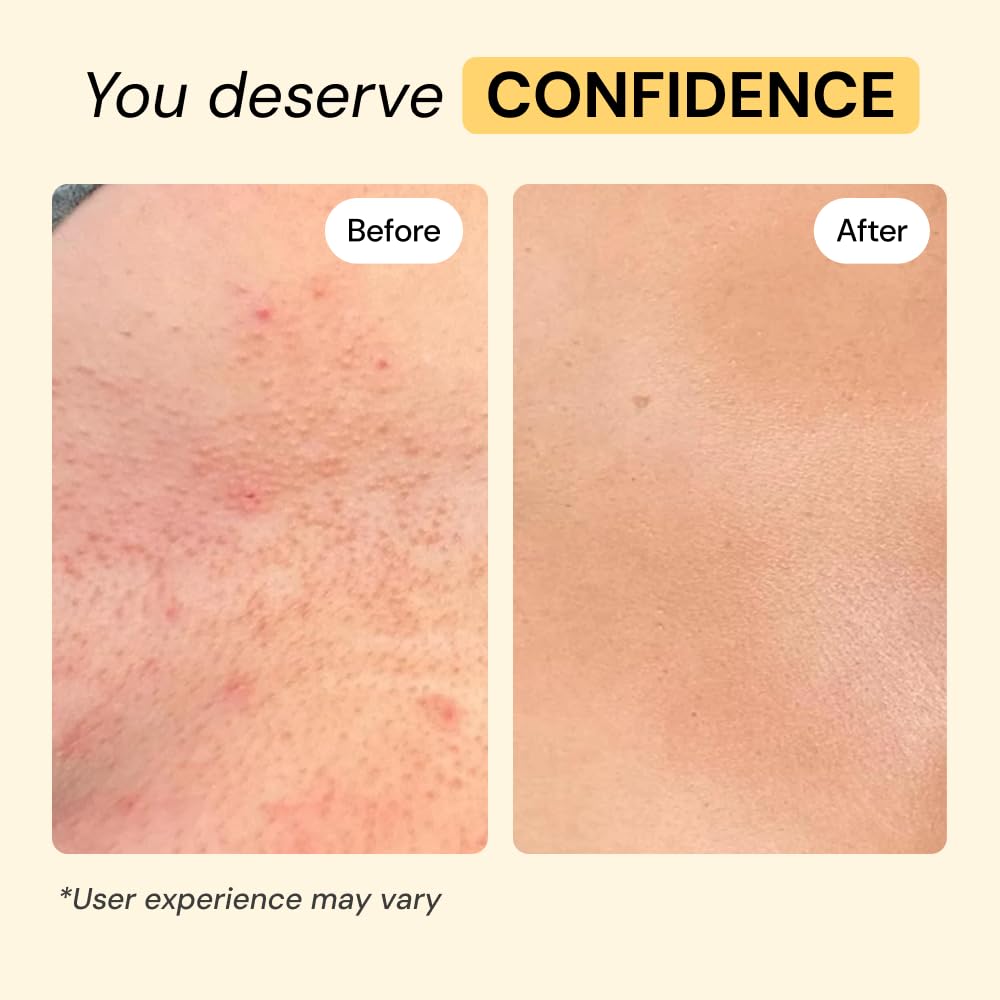 MyMagicHealer Universal Flare Care - Solution for Everyday Skin Flare-Ups | Drawing Salve for Boils & Cysts, Hidradenitis Suppurativa, Folliculitis | Beauty and Personal Care MyMagicHealer