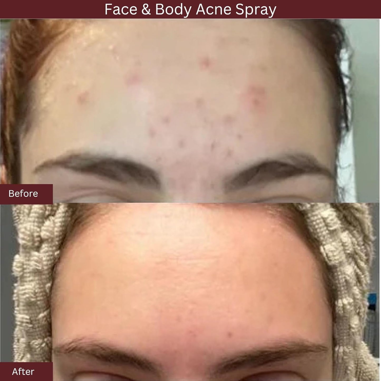 ITK Skincare 2% Salicylic Acid Spray for Face & Body Acne - Blemish-Fighting Treatment for Body Acne, Bacne, Blackheads, Pimples & Blemishes - BHA