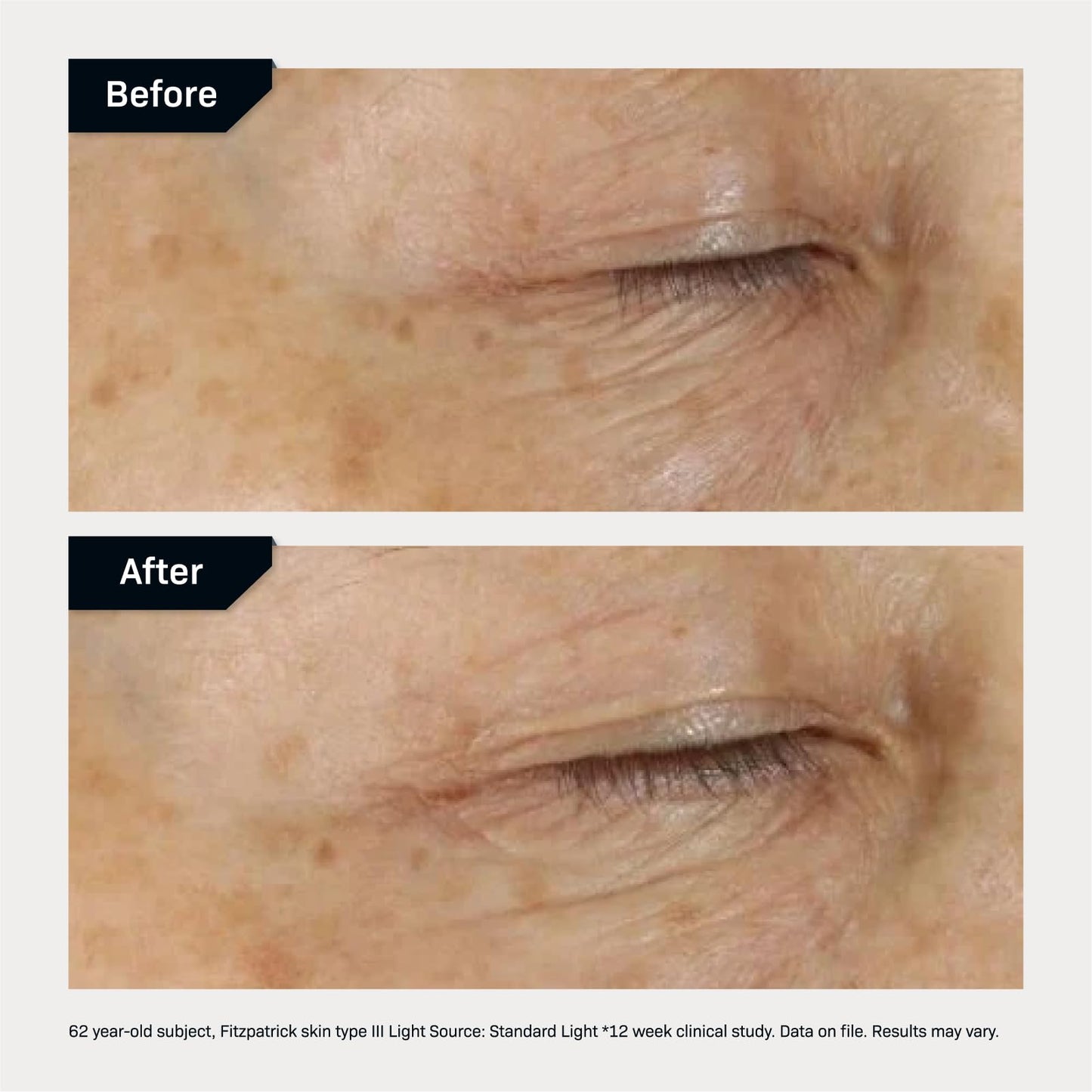Revision Skincare D·E·J Eye Cream®, Clinically Proven to Reduce Under-Eye Fine Lines and Wrinkles with Peptides and Hyaluronic Acid for a Firmer