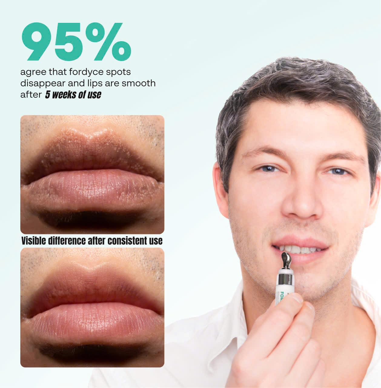 Abera Fordyce Cream - with Hydroxypinacolone retinoate(HPR), Fordyce Spot Remover For Lips, All - day Moisturizing, Help Improve Dry, Chapped and Dark Beauty and Personal Care ABERA