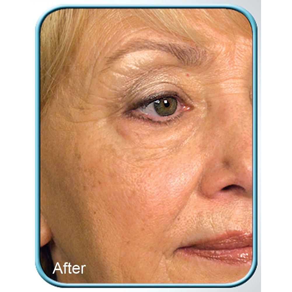 Biologic Stem Cell Therapy (Set of 4 Jars) for Deep Wrinkles - by BioLogic