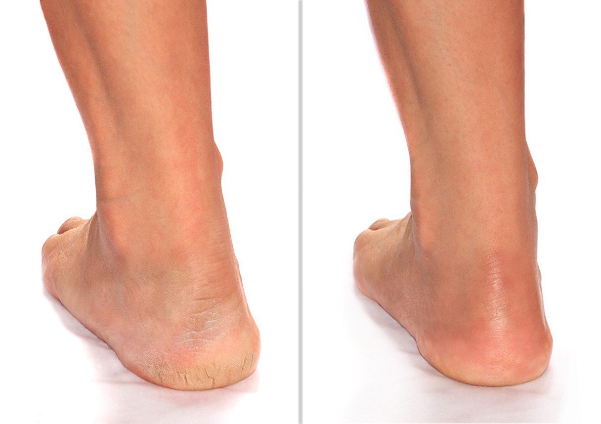 Advanced Clinicals Cracked Heel Foot Cream Skin Care Moisturizer Lotion For Feet W/Shea Butter | Helps Heal Cracked Skin, Rough Spots, Calluses, & Dry