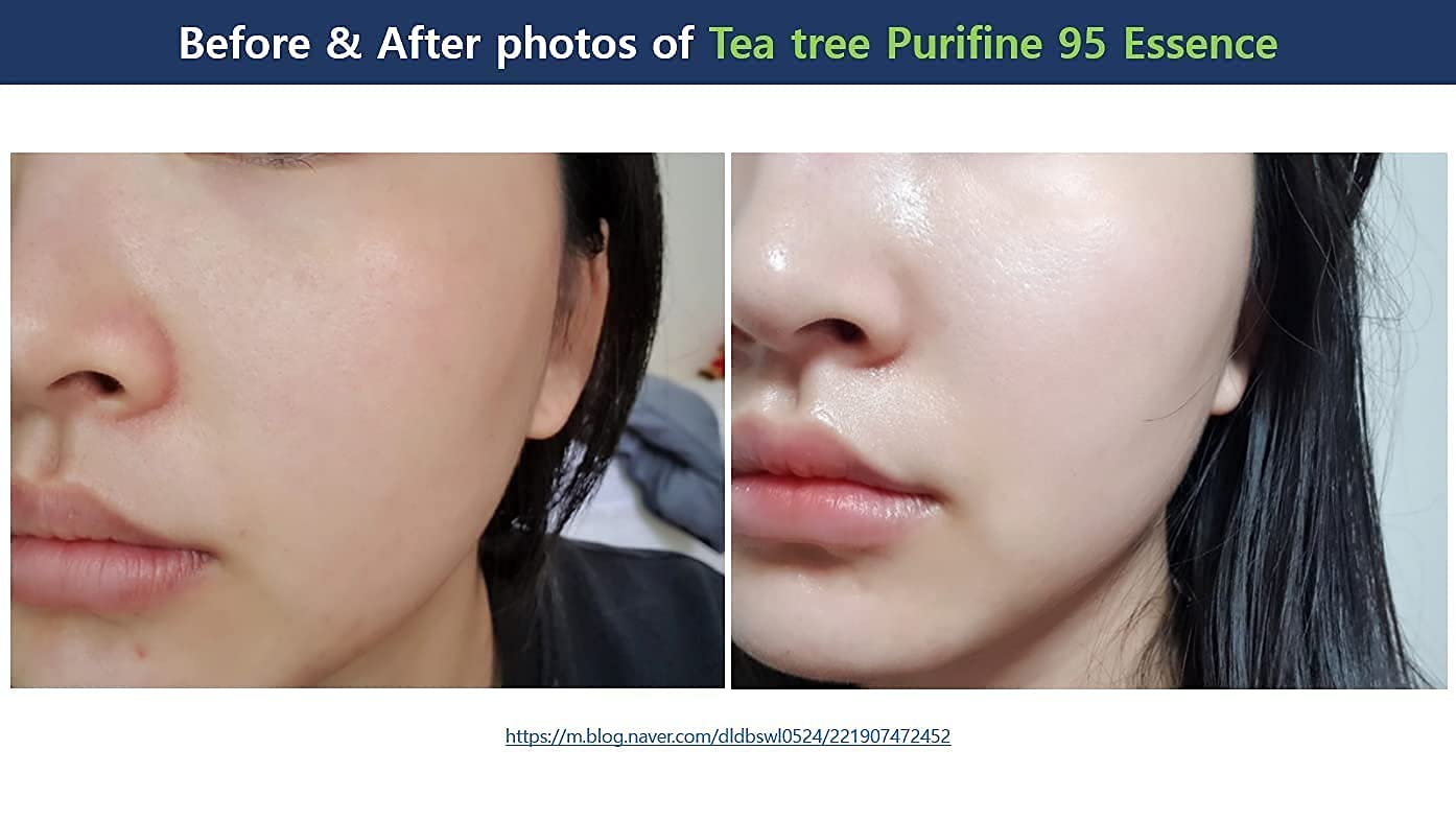 Dr.Ceuracle Tea Tree Purifine Essence - Mild Facial Serum for Sensitive Skin, Redness and Sebum Reducing Korean Skin Care (50ml / 1.69 fl. oz.) Beauty & Personal Care leegeehaam