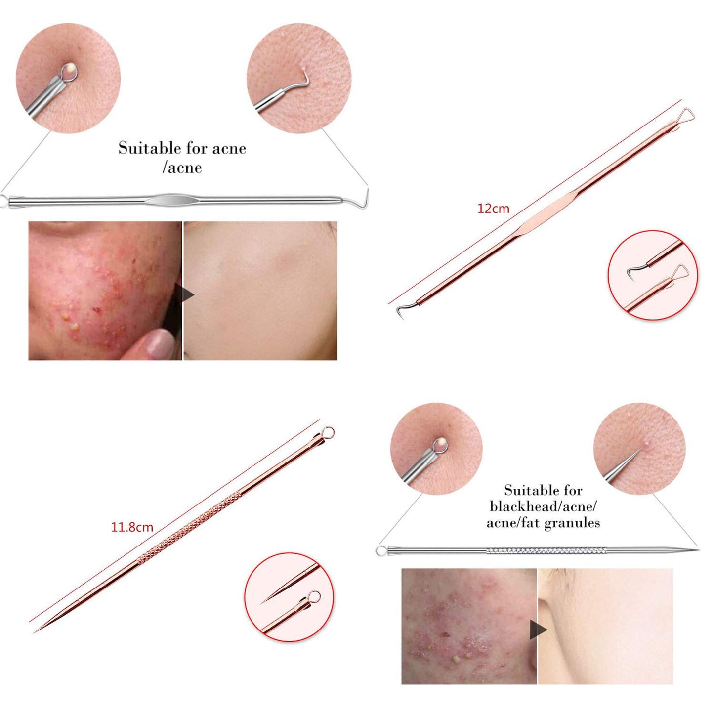 ZTRHYOO Blackhead Remover Pimple Comedone Extractor Tool Best Acne Removal Kit - Treatment for Blemish, Whitehead Popping, Zit Removing for Risk Free Beauty and Personal Care ZTRHYOO