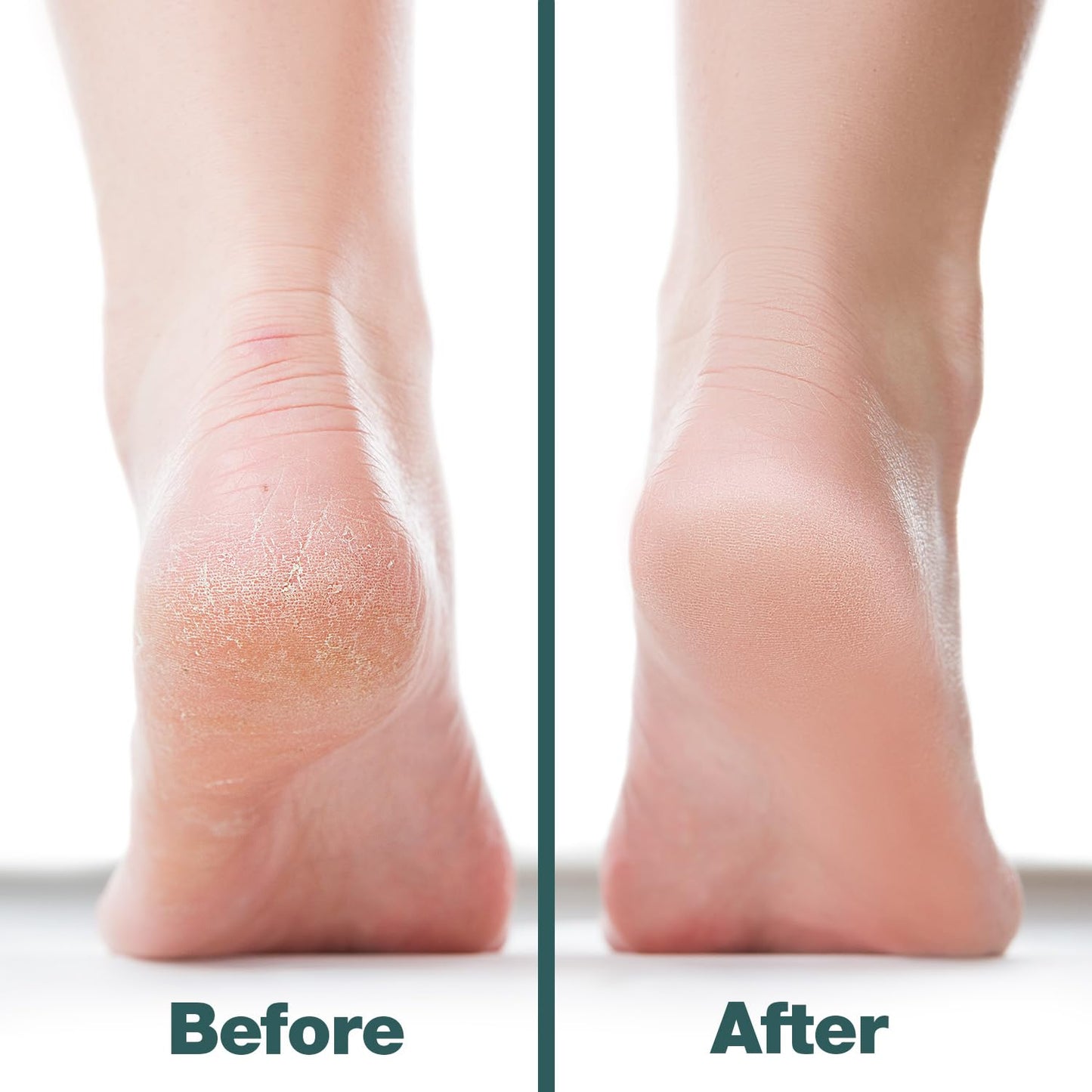 Probelle Double Sided Multidirectional Nickel Foot File Callus Remover - Immediately Reduces calluses and Corns to Powder for Instant Results, Safe
