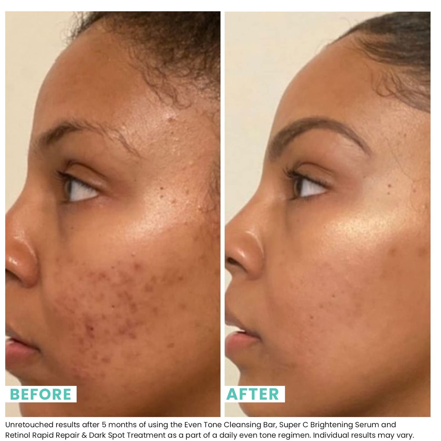 Urban Skin Rx® Even Tone Cleansing Bar | 3-in-1 Multitasking Treatment Daily Cleanser, Exfoliator, & Mask | Targets Uneven Skin & Improves the