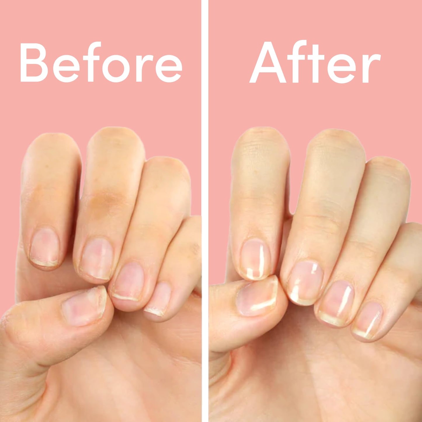 ella+mila "First Aid Kiss" Nail Strengthener and Growth treatment- Nail Repair Solution & Growth Treatment for Thin, Brittle & Damaged Nails - Nail