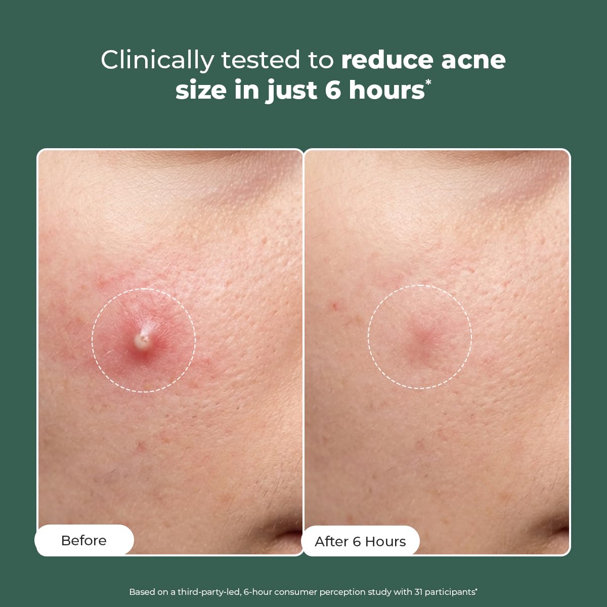 Acne Spot Corrector Gel Serum