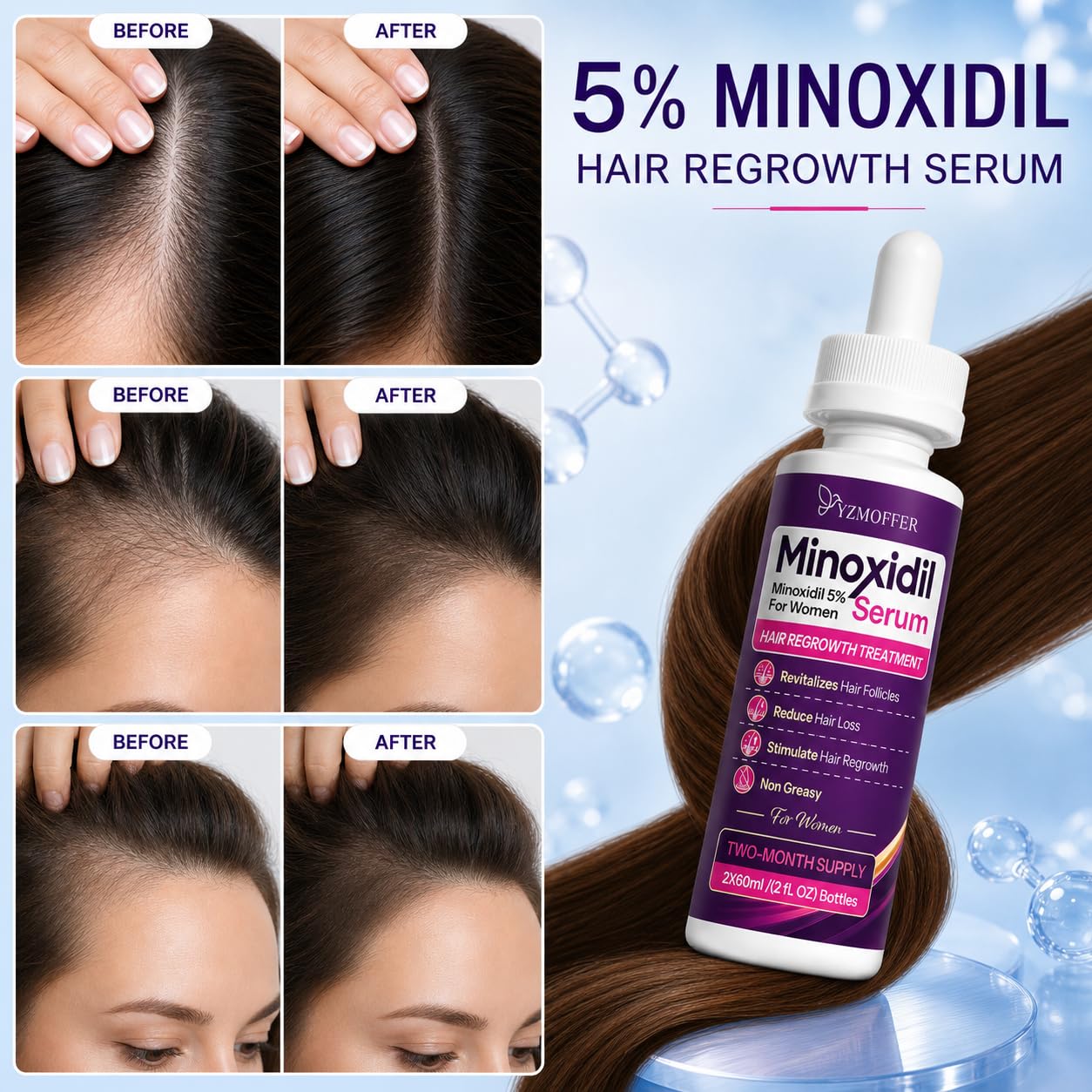 Minoxidil 5% Hair Regrowth Treatment for Women, Topical Serum Drops for Thinning Hair, Revitalizes Hair Follicles, Reduces Hair Loss, Non-Greasy Beauty and Personal Care Yzmoffer