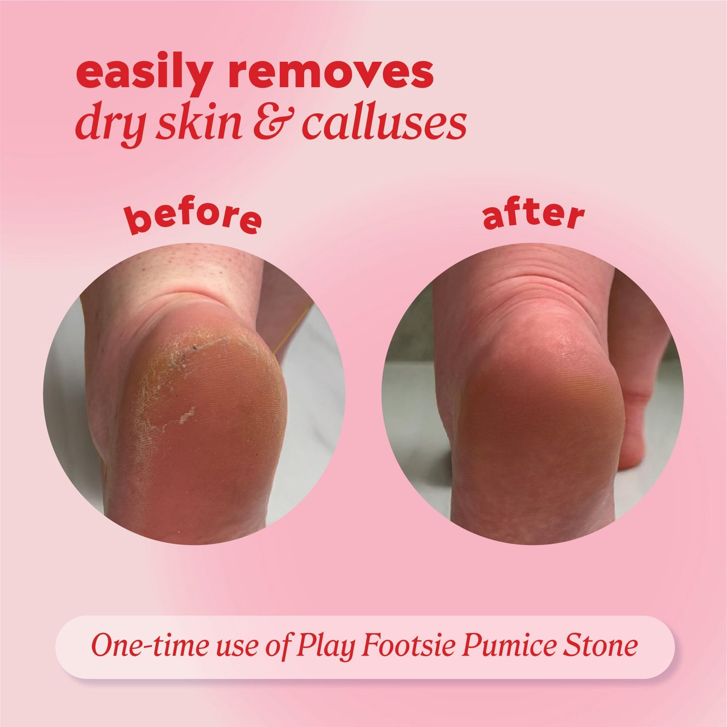 Onyx Professional Double Sided Pumice Stone, 2 Pack - 100% Siliglass Callus Remover for Feet, Elbows, Knees, Dead Skin, Heels, Hands, Foot File Beauty and Personal Care Onyx Professional
