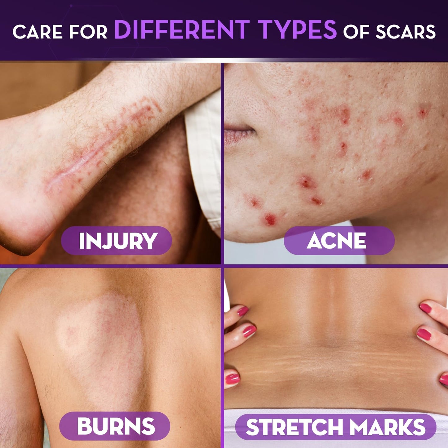 Cicatricure Advanced Scar Gel for Face & Body - Proven Results in 2 Weeks, Scar Treatment for Surgical Scars, Stretch Marks, Scars of Burns