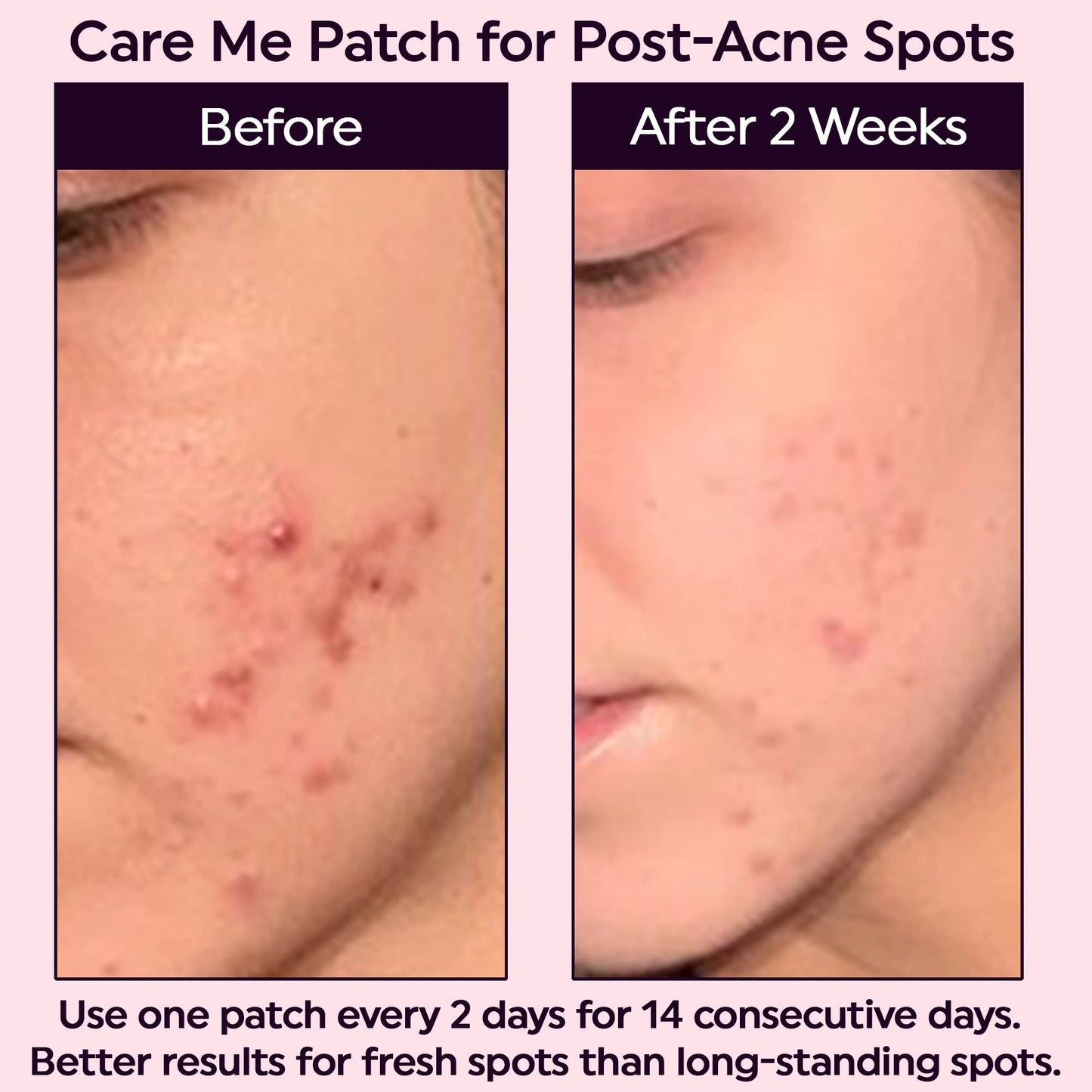 Microdart Dark Spot Patch with 127 Micropoints (1 Pack of 9 Patches) - Fades & Brightens Acne Marks, Dark Spots & Discoloration - Post-Acne Treatment