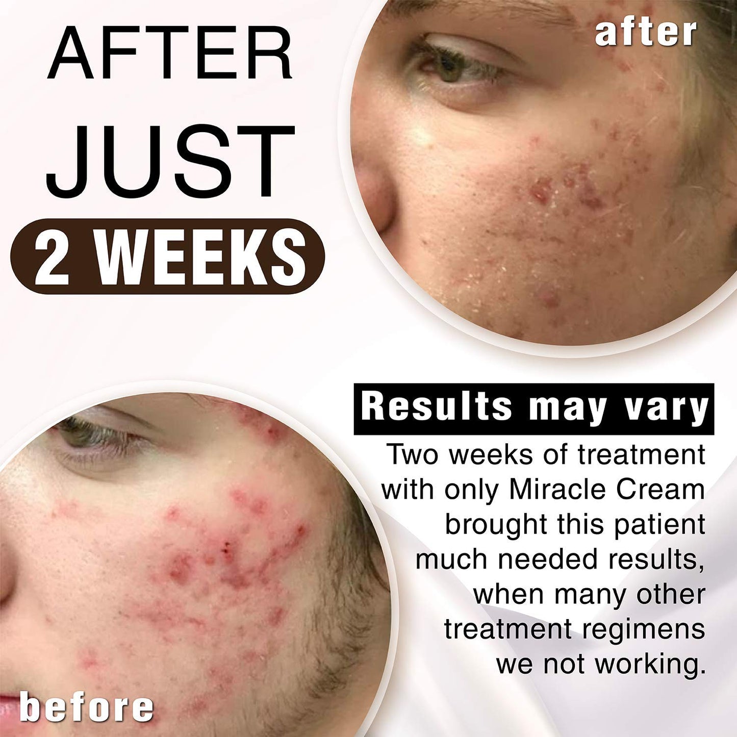 Anna Guanche MD Miracle Cream - Acne Treatment that Quickly Reduces Pimples & Redness