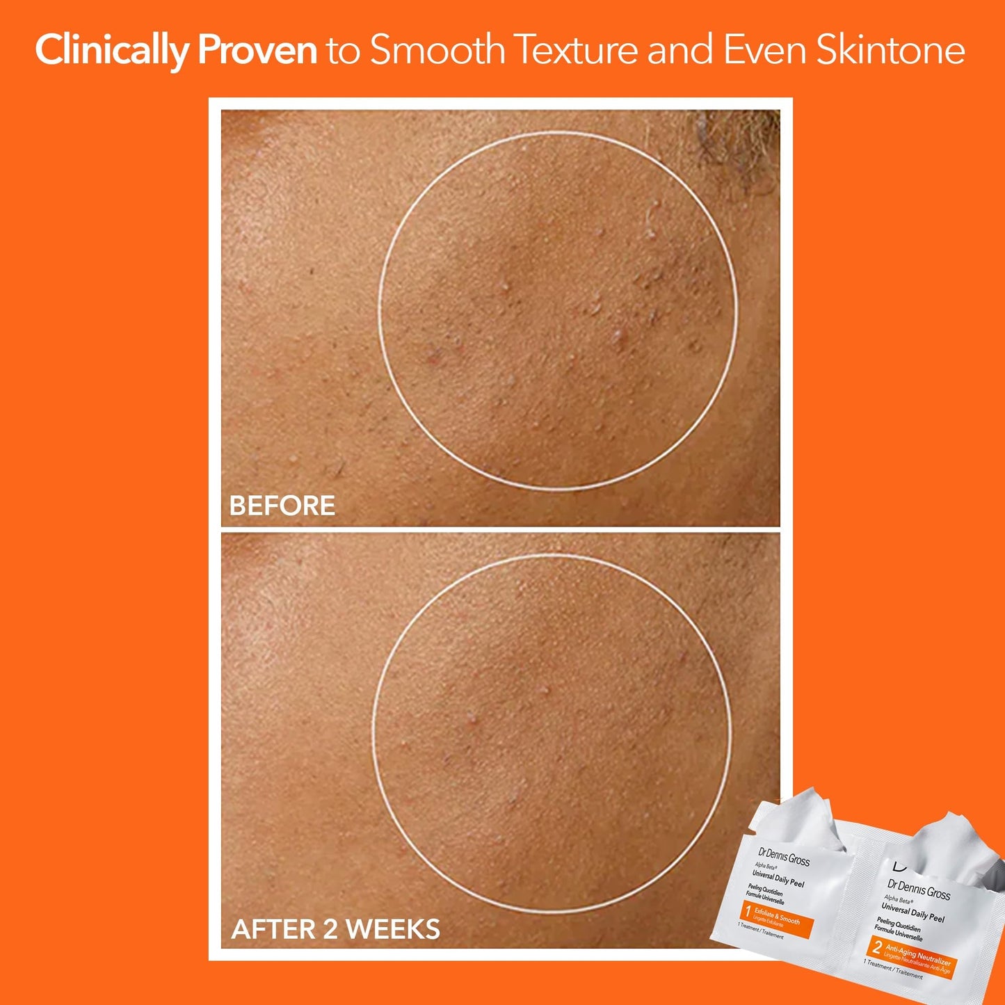 Dr Dennis Gross Alpha Beta Universal Daily Peel: for Uneven Tone or Texture and Fine Lines or Enlarged Pores, (5 Treatments) Beauty and Personal Care Dr Dennis Gross