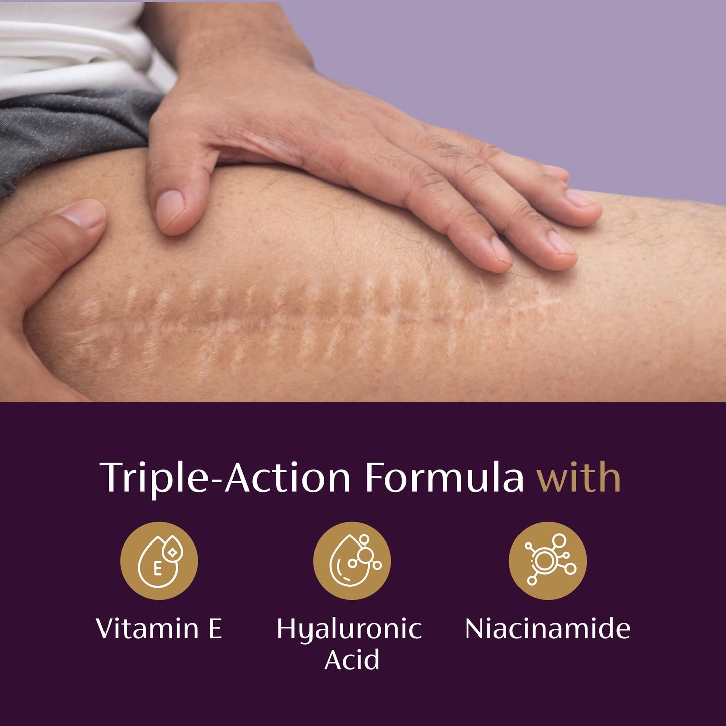 Mederma Scar Serum - Triple-Action Formula with Vitamin E, Hyaluronic Acid & Niacinamide - Clinically Shown to Reduce Old Scars, 1 Fl. Oz. Beauty and Personal Care Mederma