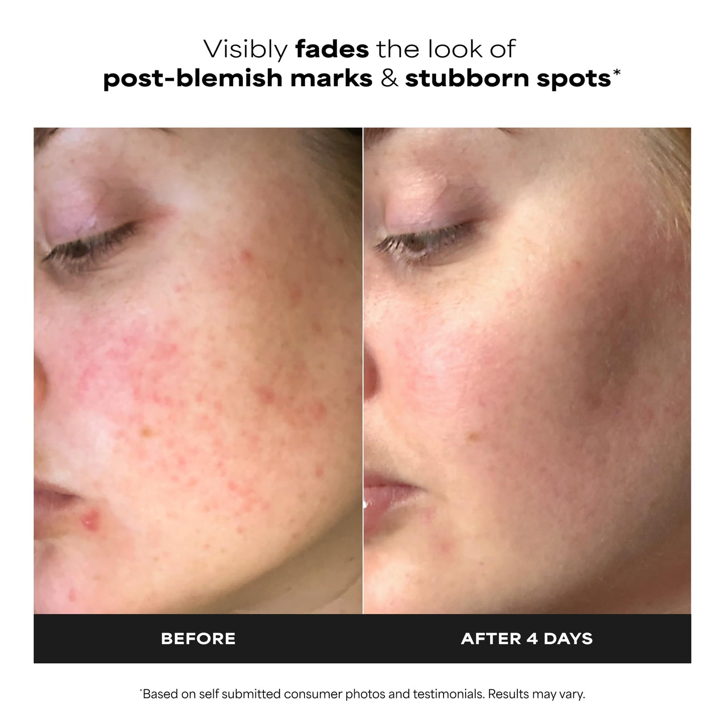 Paula’s Choice BOOST 10% Azelaic Acid Booster Cream Gel, Oil-Free Serum Fades Discoloration & Post-Blemish Marks, with Licorice Extract & Salicylic Beauty and Personal Care Paula's Choice